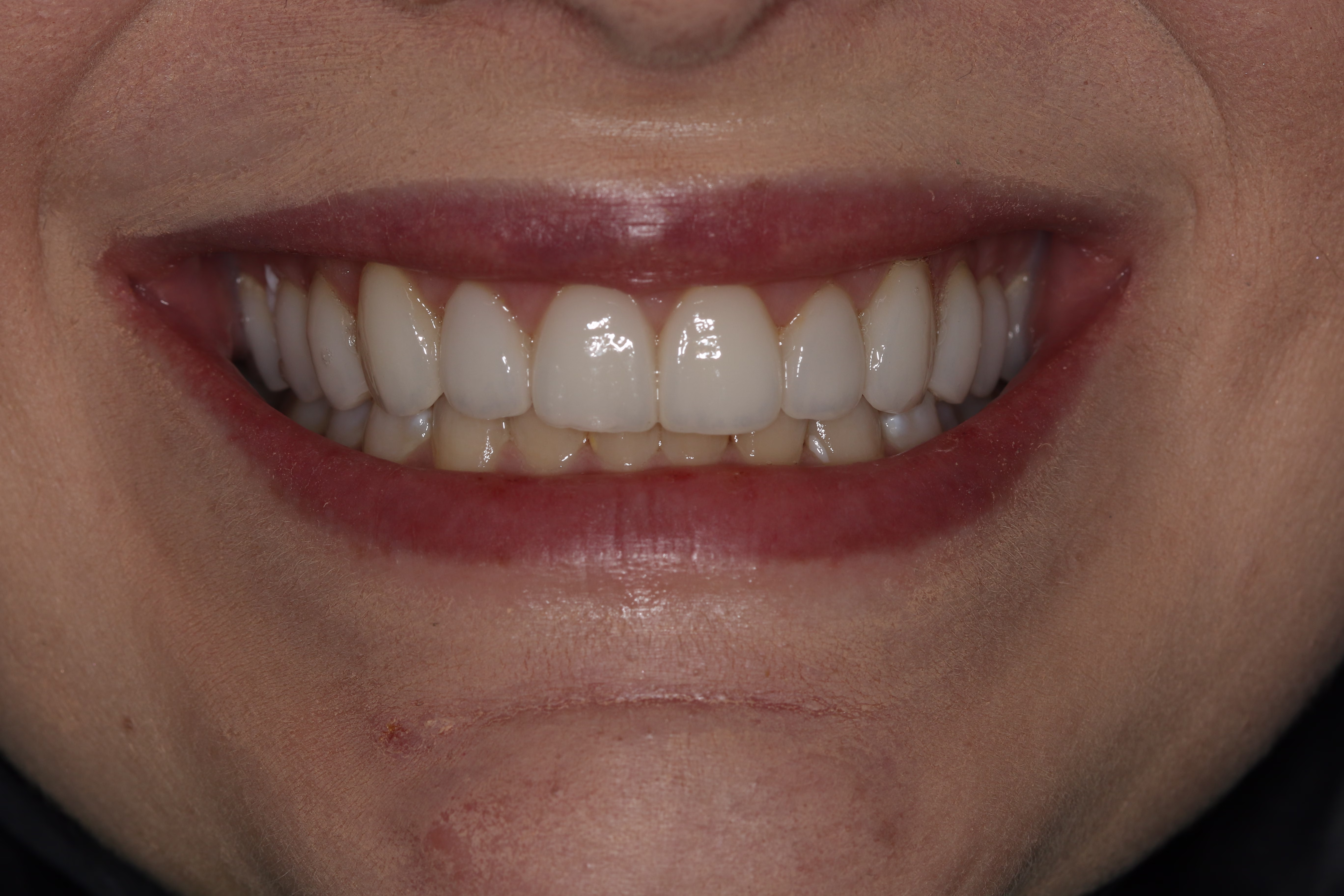 DC cosmetic dentirstry patient veneers dental implants after