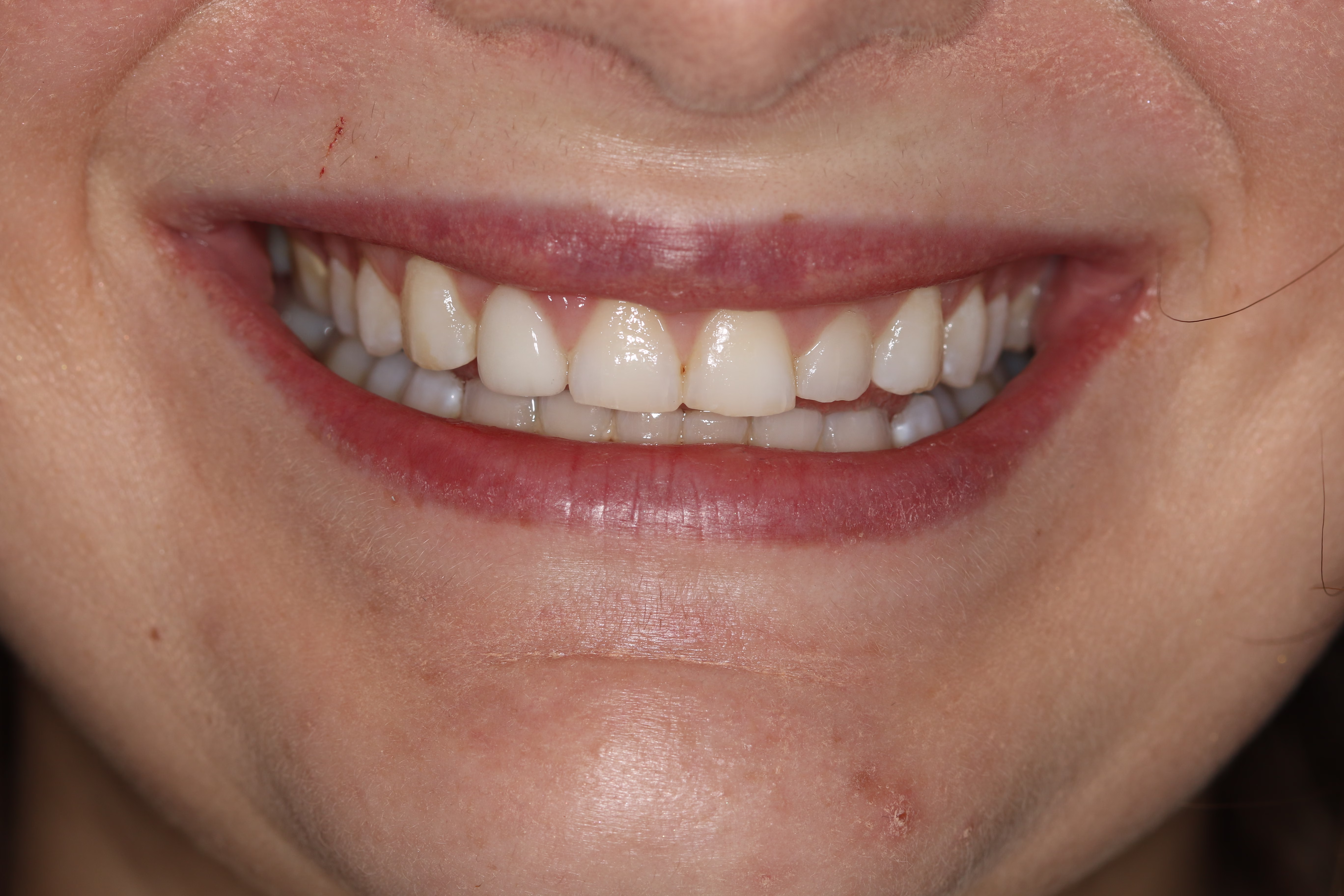 DC cosmetic dentirstry patient veneers dental implants before