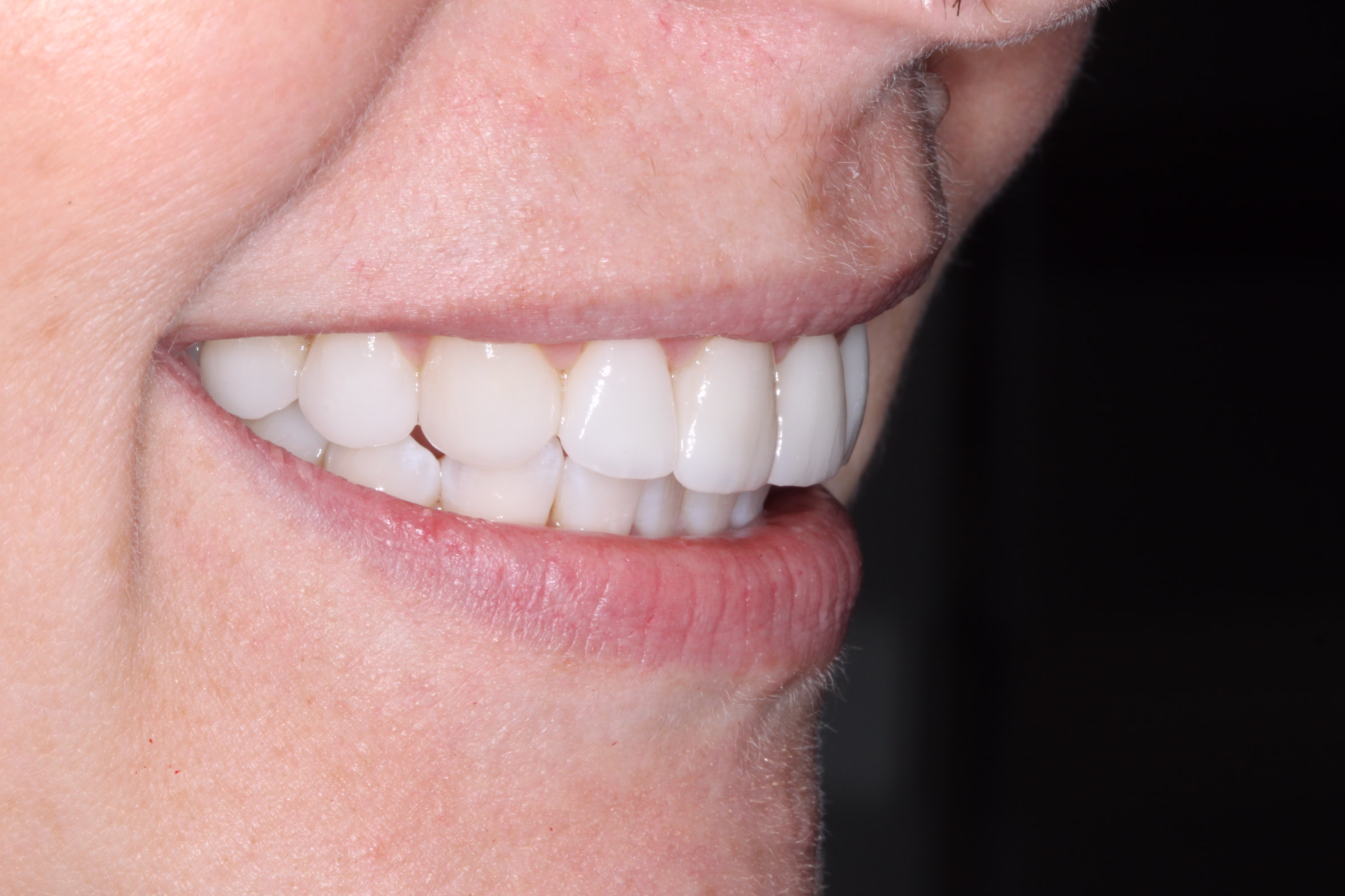 DC cosmetic dentistry patient veneers and whitening after