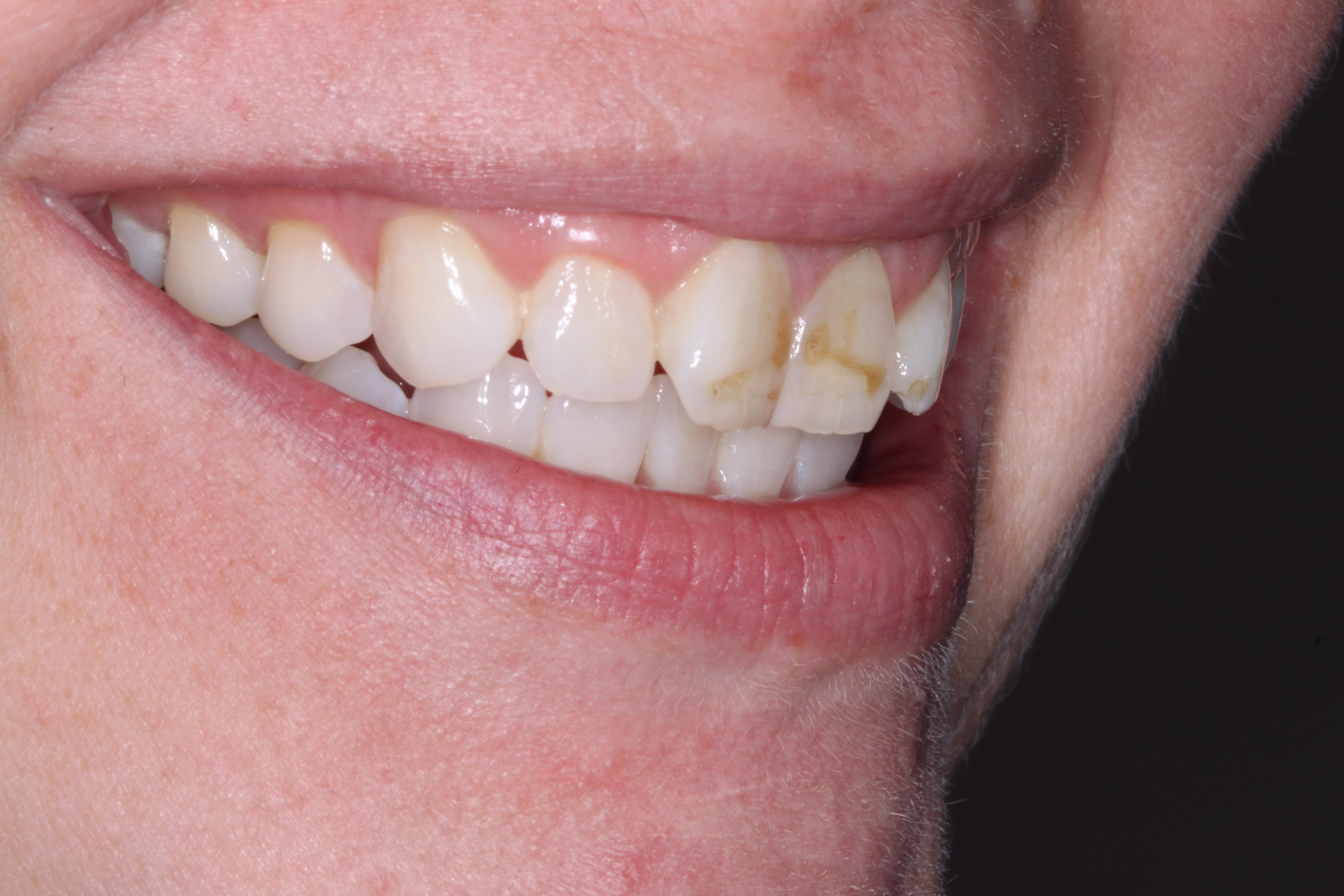 DC cosmetic dentistry patient veneers and whitening before