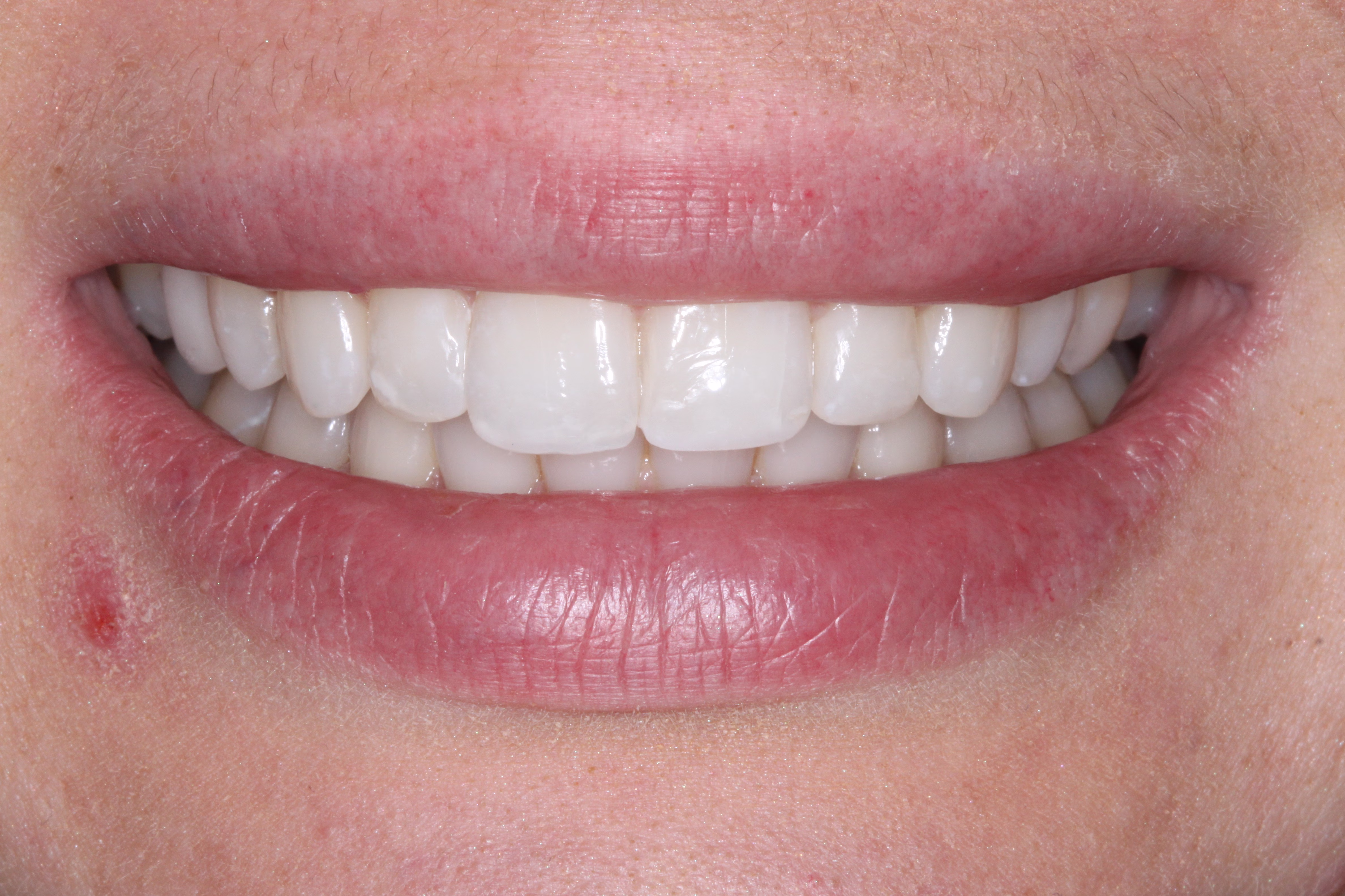DC cosmetic dentsitry patient with invisalign whitening and bondings after - Alina's Smile Story DC cosmetic dentsitry patient with invisalign whitening and bondings after