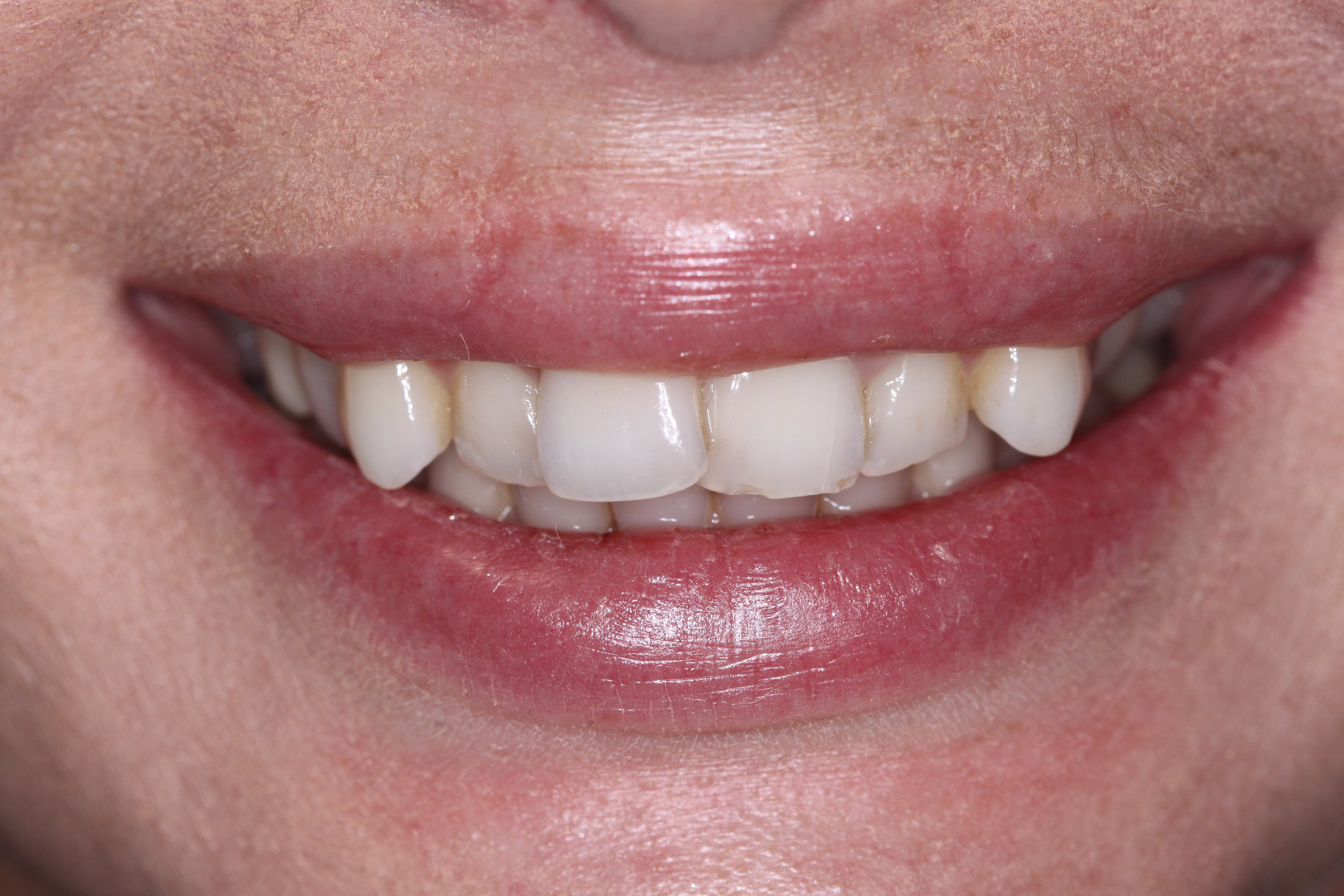 DC cosmetic dentsitry patient with invisalign whitening and bondings before - Alina's Smile Story DC cosmetic dentsitry patient with invisalign whitening and bondings before