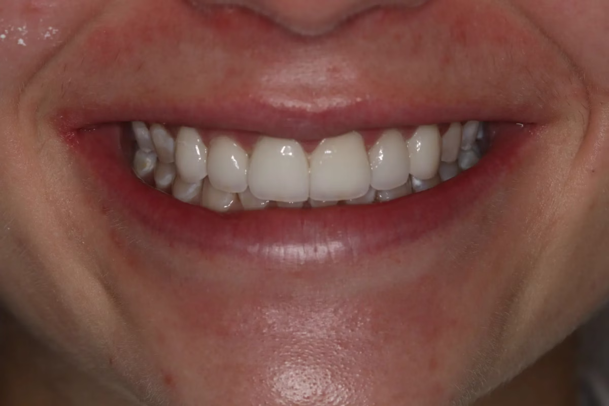 Dentistry Washington DC Changing discolored bonding to porcelain veneers after - Smile Gallery Dentistry Washington DC Changing discolored bonding to porcelain veneers after
