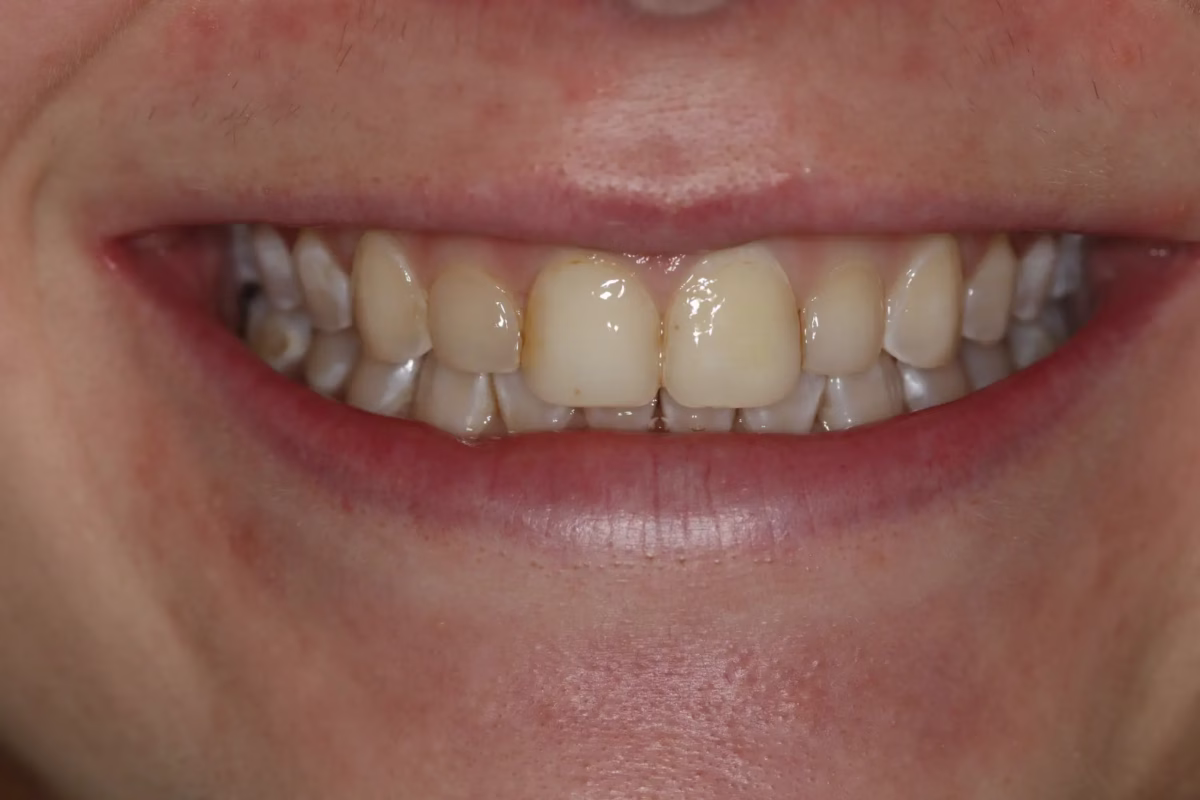 Dentistry Washington DC Changing discolored bonding to porcelain veneers before - Smile Gallery Dentistry Washington DC Changing discolored bonding to porcelain veneers before