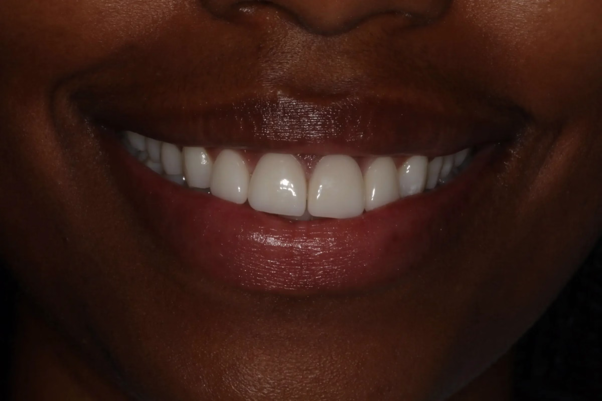 Dentistry Washington DC Comparing Porcelain Veneers and Prepless Veneers before1 scaled 1