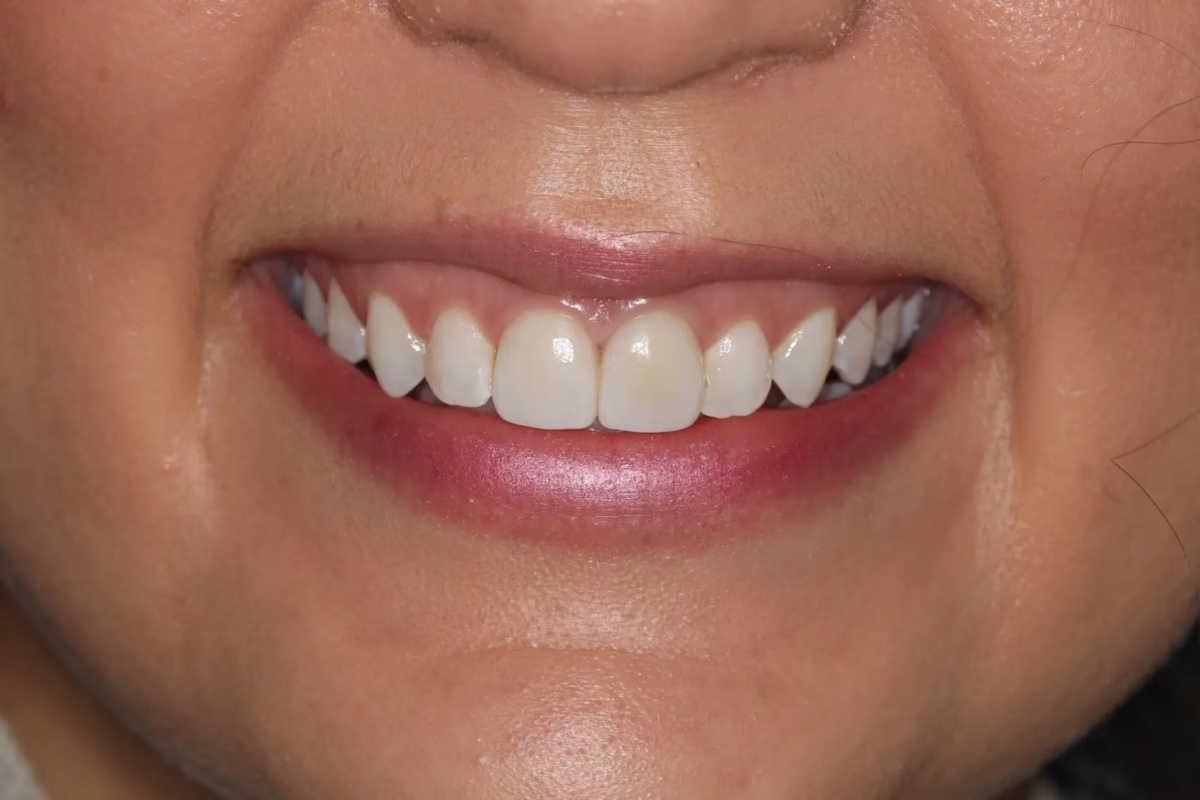 Dentistry Washington DC Crowns And Bridges after