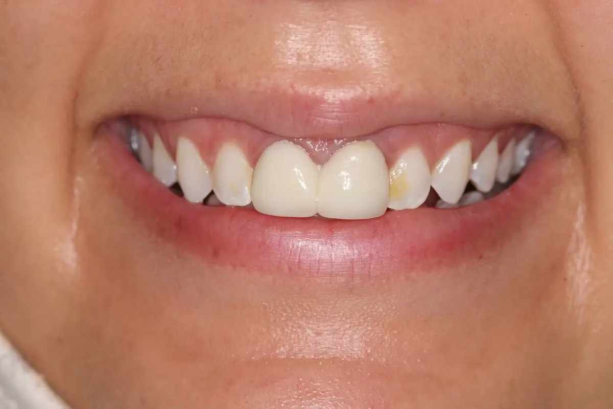 Dentistry Washington DC Crowns And Bridges before