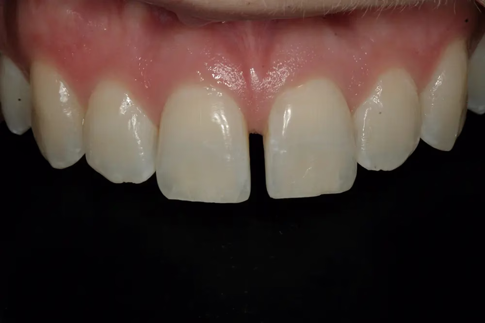 Dentistry Washington DC Dental Bonding Before
