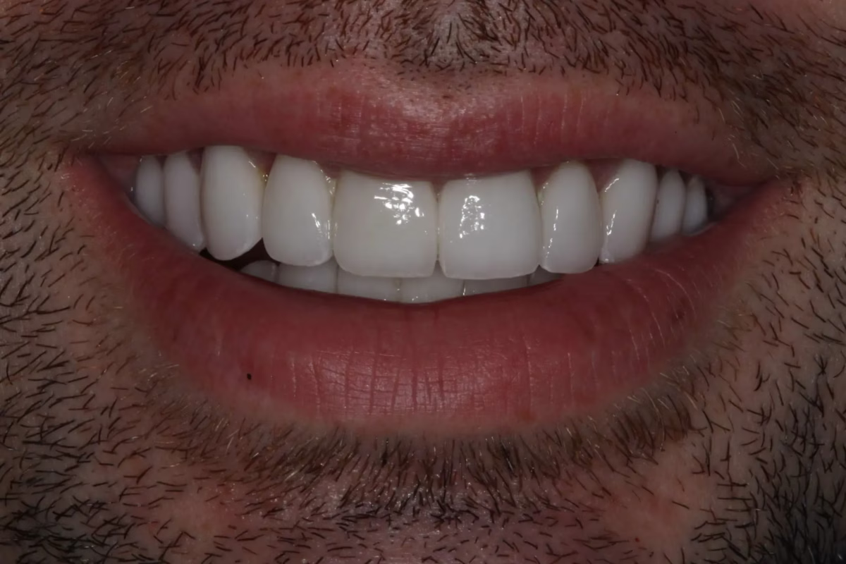 Dentistry Washington DC Full Mouth Reconstruction After