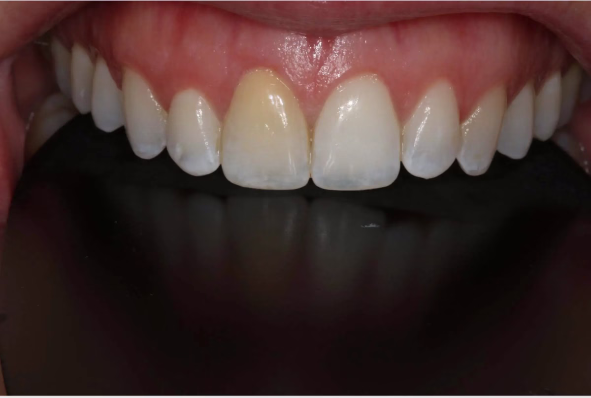 Dentistry Washington DC KOR Whitening Before