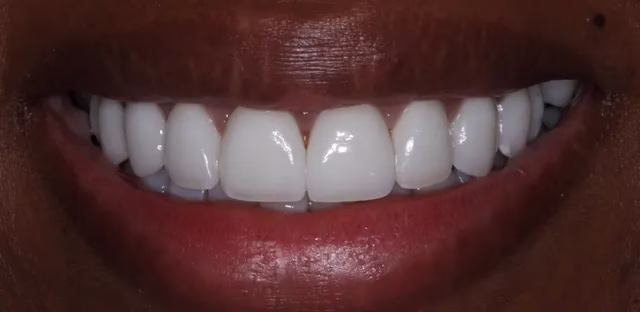 Dentistry Washington DC The Benefits of Veneers after