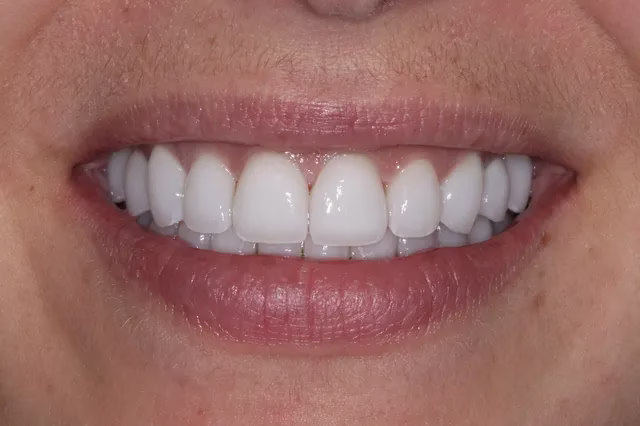 Dentistry Washington DC The Procedure for Veneers after1