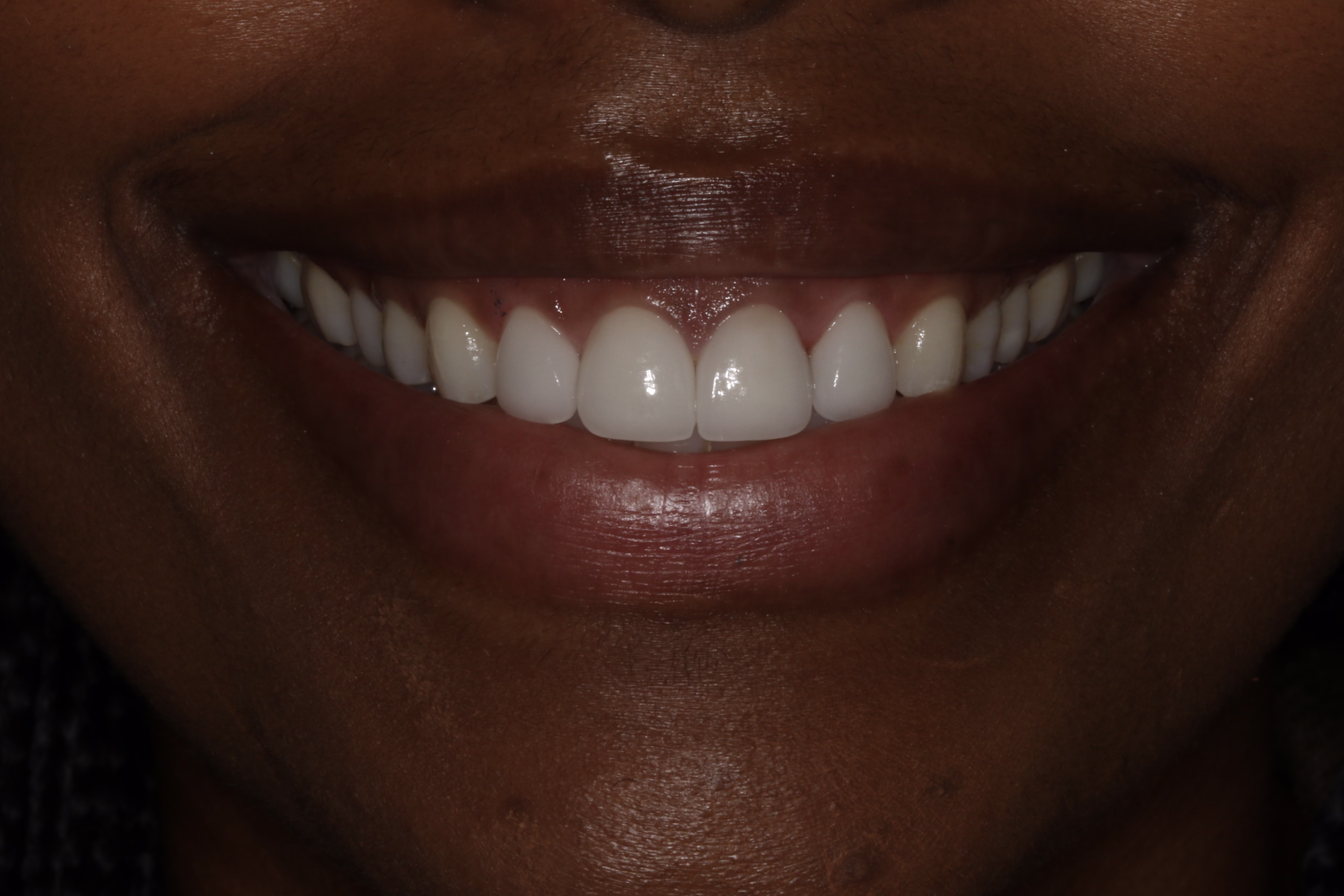 Georgetown Cosmetic Dentistry Veneers and Whitening patient after - Jessica's Smile Story Georgetown Cosmetic Dentistry Veneers and Whitening patient after