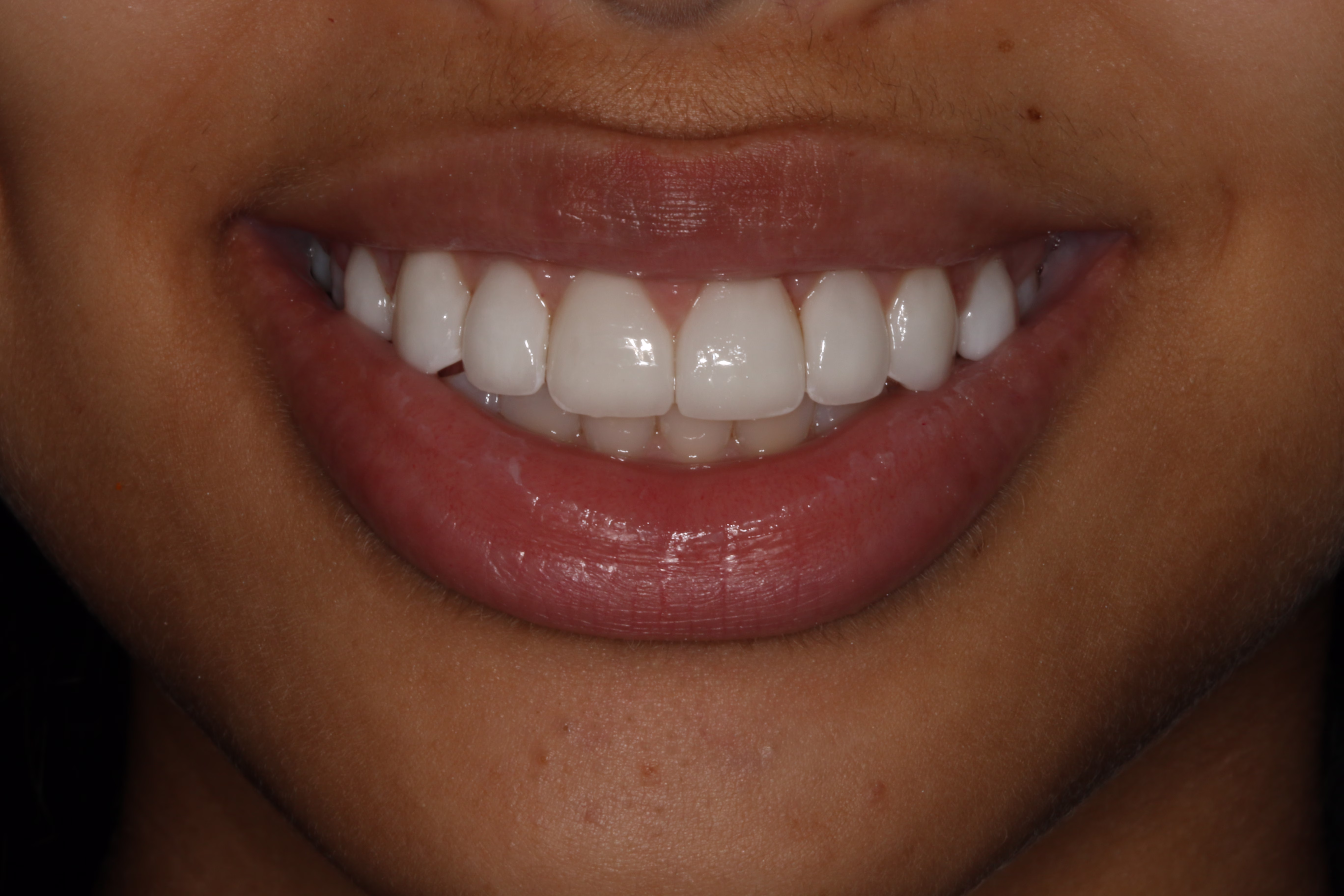 Georgetown Cosmetic Dentistry patient Whitening and Veneers after