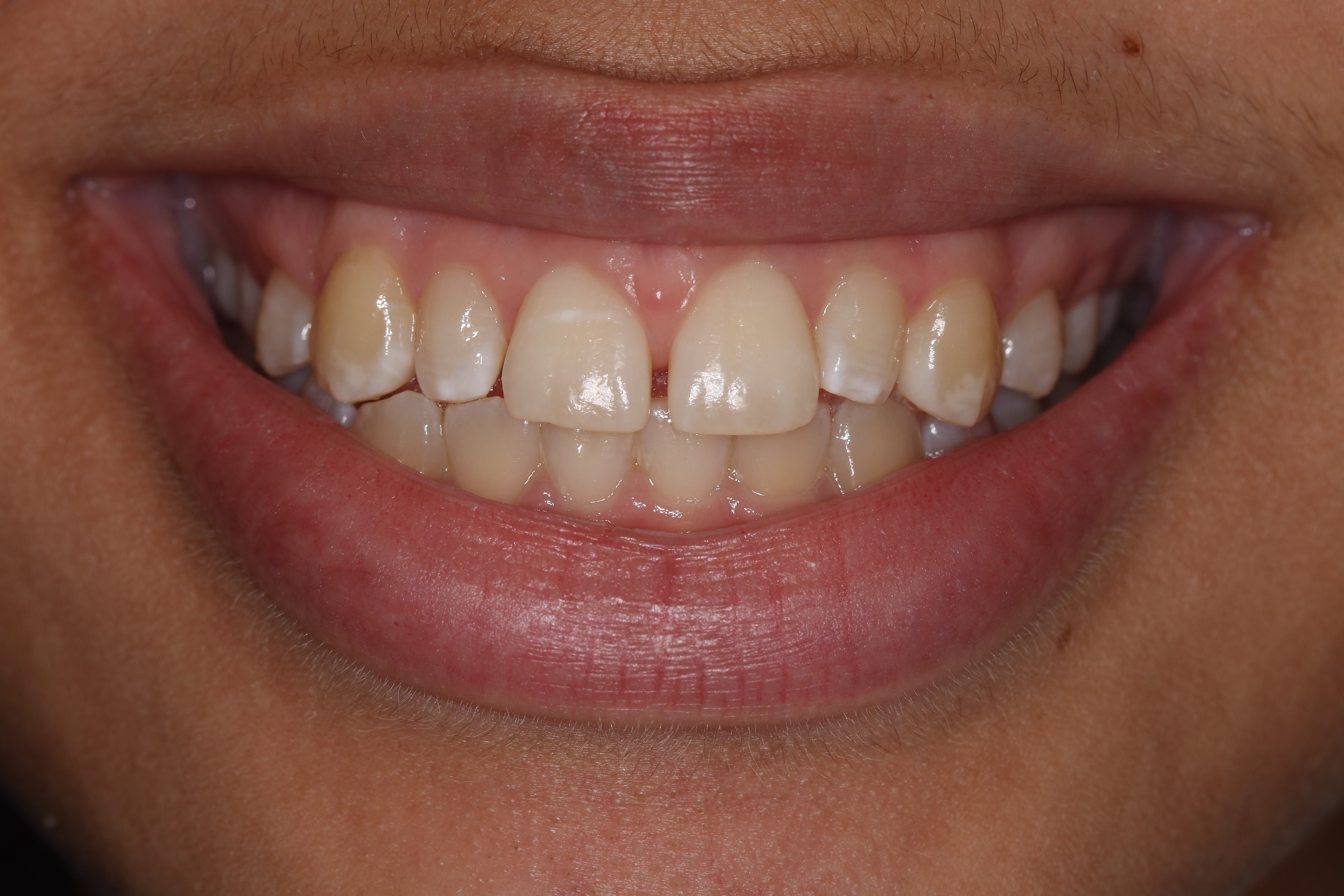 Georgetown Cosmetic Dentistry patient Whitening and Veneers before