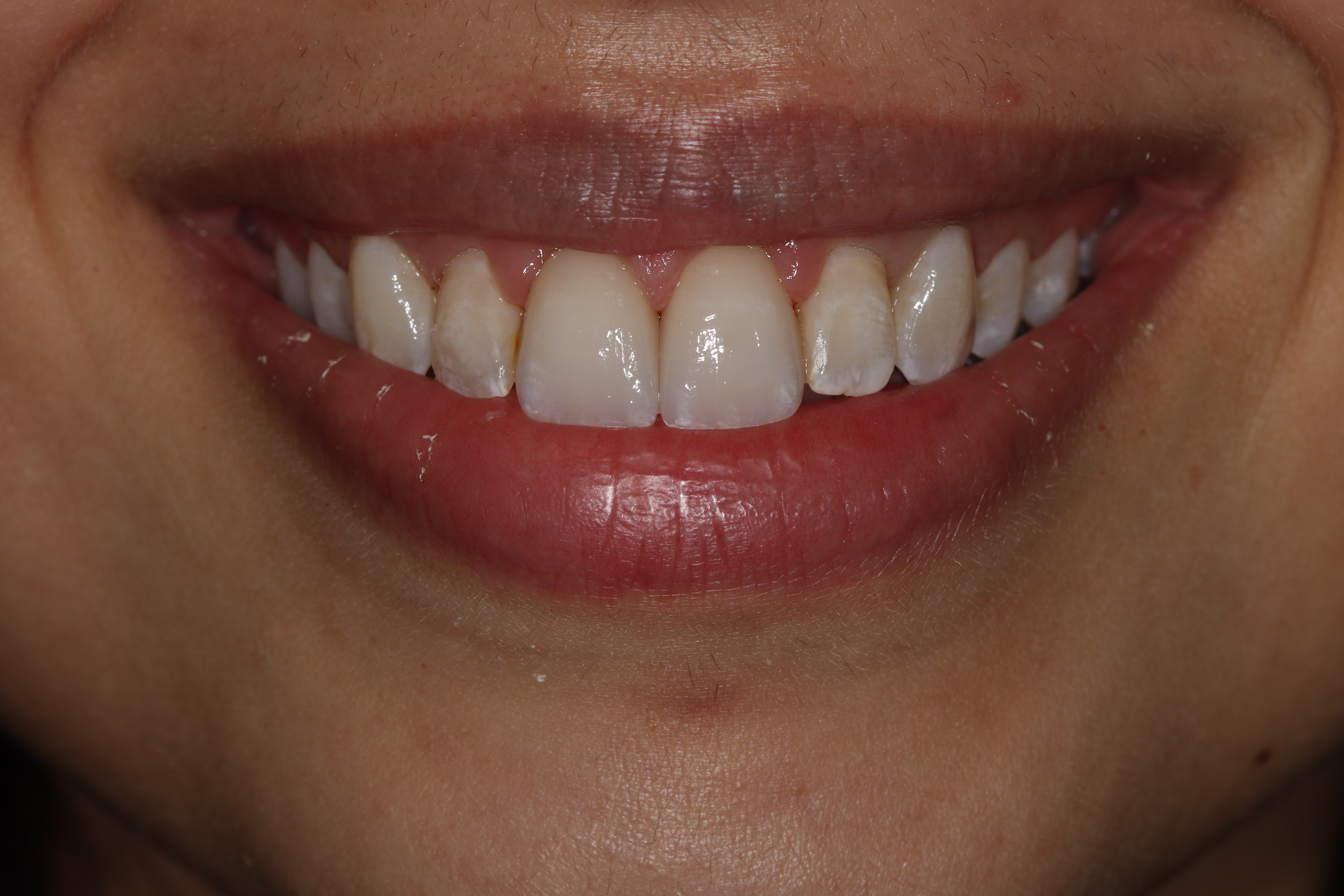 Georgetown DC Cosmetic Dentistry Patient Veneers and Whitening Emergency treament after