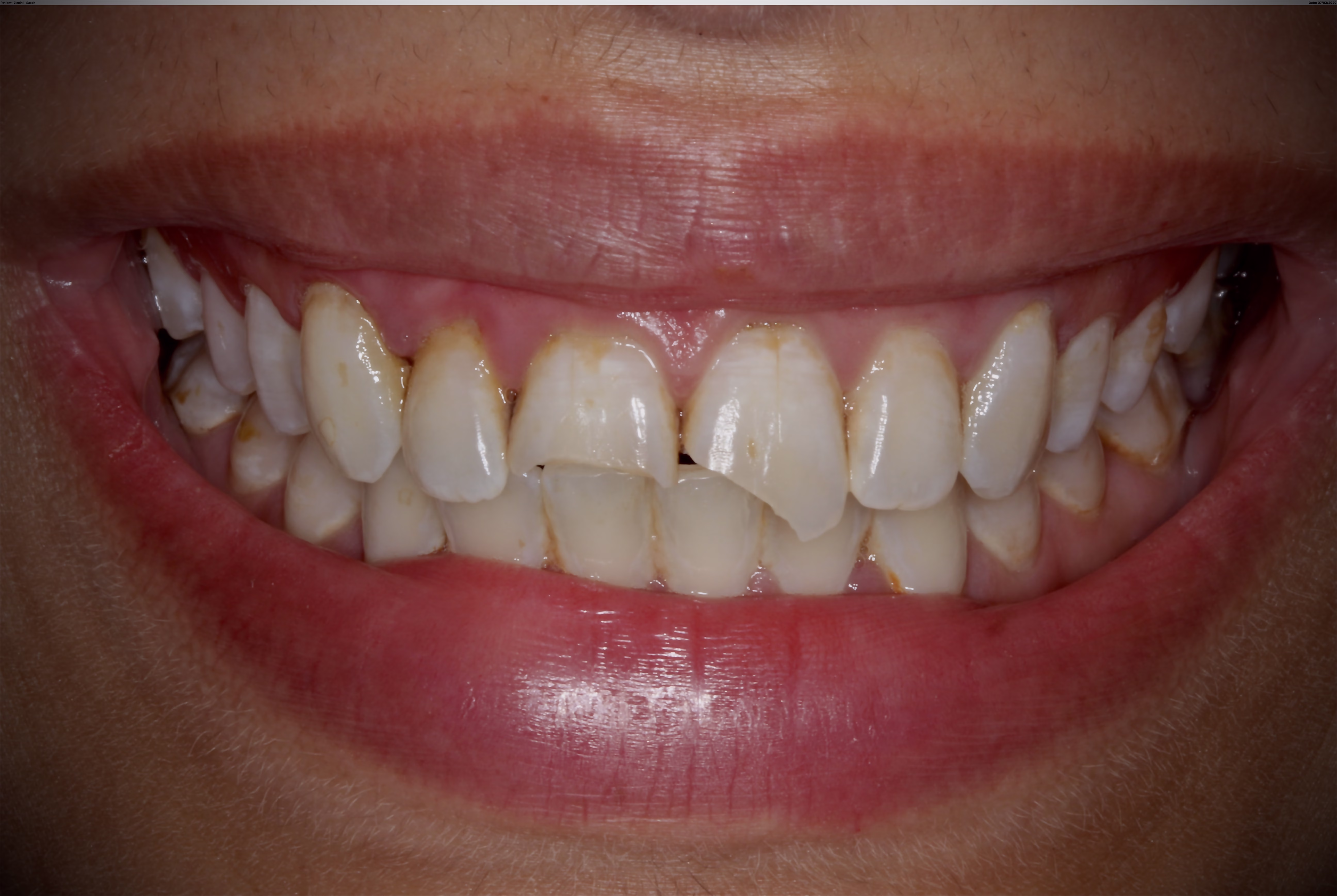 Georgetown DC Cosmetic Dentistry Patient Veneers and Whitening Emergency treament before