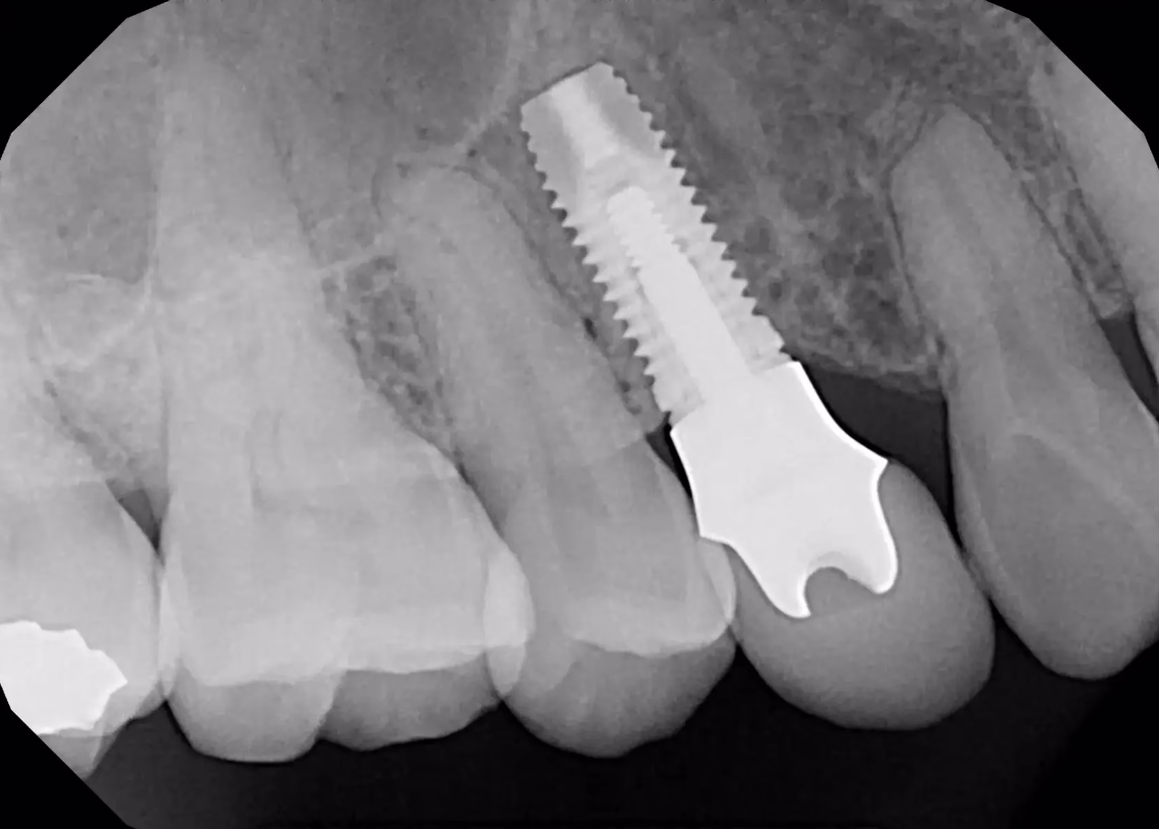 Georgetown Dentistry Dental Implants - Dental Implants Georgetown Dentistry Dental Implants
