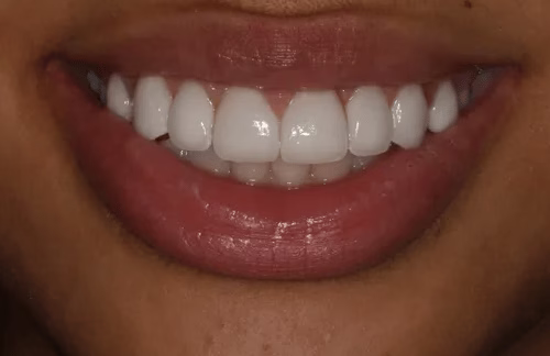 Georgetown Dentistry Smile Gallery Dentistry Washington DC Smile Gallery Image10 - Smile Gallery Georgetown Dentistry Smile Gallery Dentistry Washington DC Smile Gallery Image10