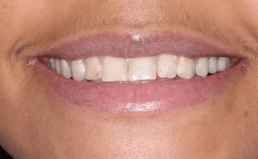 Georgetown Dentistry Smile Gallery Dentistry Washington DC Smile Gallery Image14 - Smile Gallery Georgetown Dentistry Smile Gallery Dentistry Washington DC Smile Gallery Image14