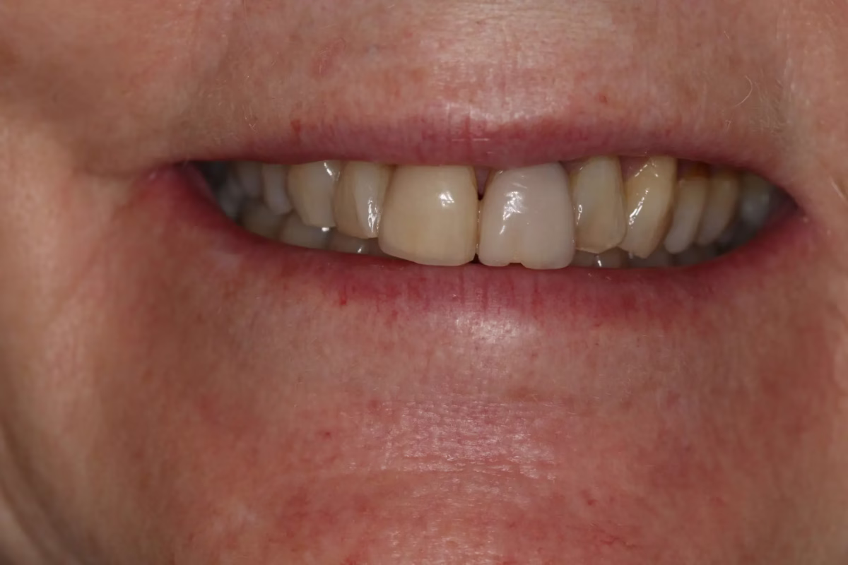 Georgetown Dentistry Smile Gallery Dentistry Washington DC Smile Gallery Image7 - Smile Gallery Georgetown Dentistry Smile Gallery Dentistry Washington DC Smile Gallery Image7