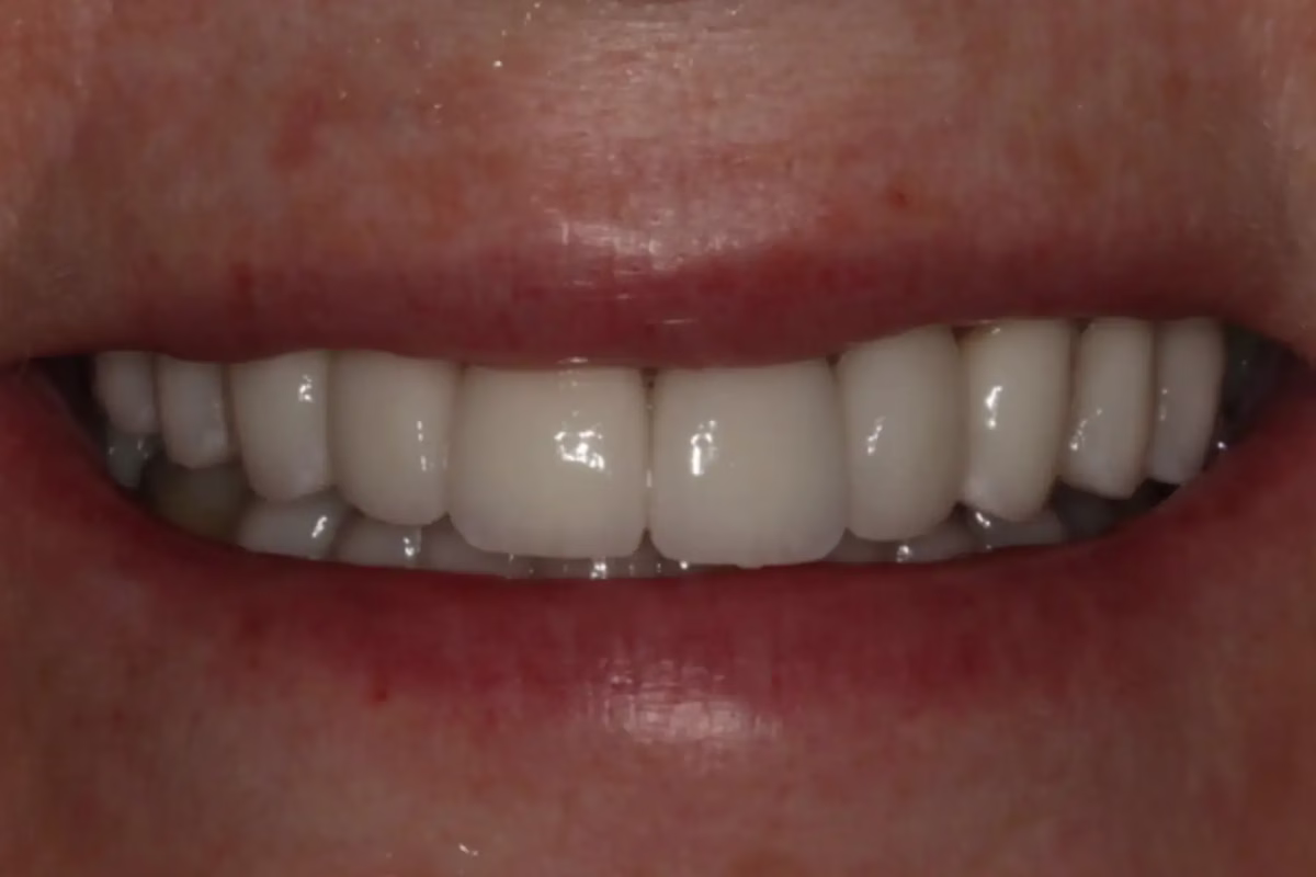 Georgetown Dentistry Smile Gallery Dentistry Washington DC Smile Gallery Image8 - Smile Gallery Georgetown Dentistry Smile Gallery Dentistry Washington DC Smile Gallery Image8