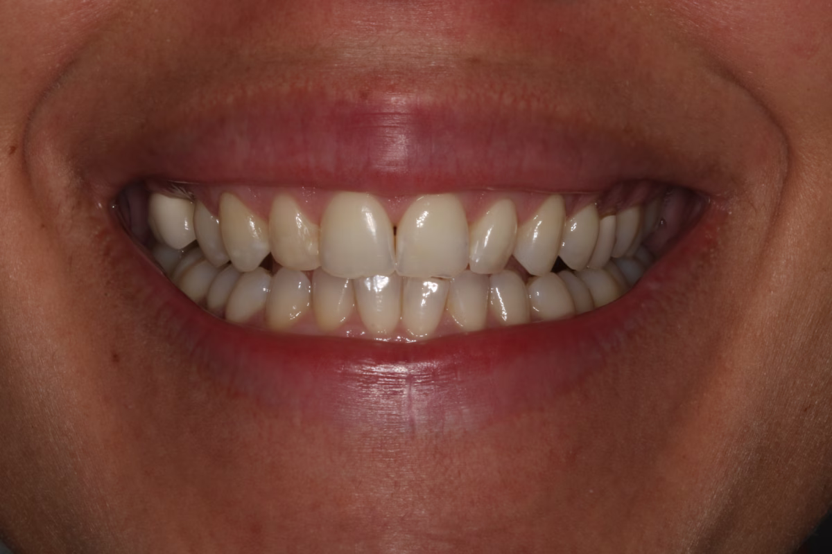Georgetown Dentistry Smile Gallery Georgetown Dentistry Smile Gallery after gum recontouring migrated - Smile Gallery Georgetown Dentistry Smile Gallery Georgetown Dentistry Smile Gallery after gum recontouring migrated