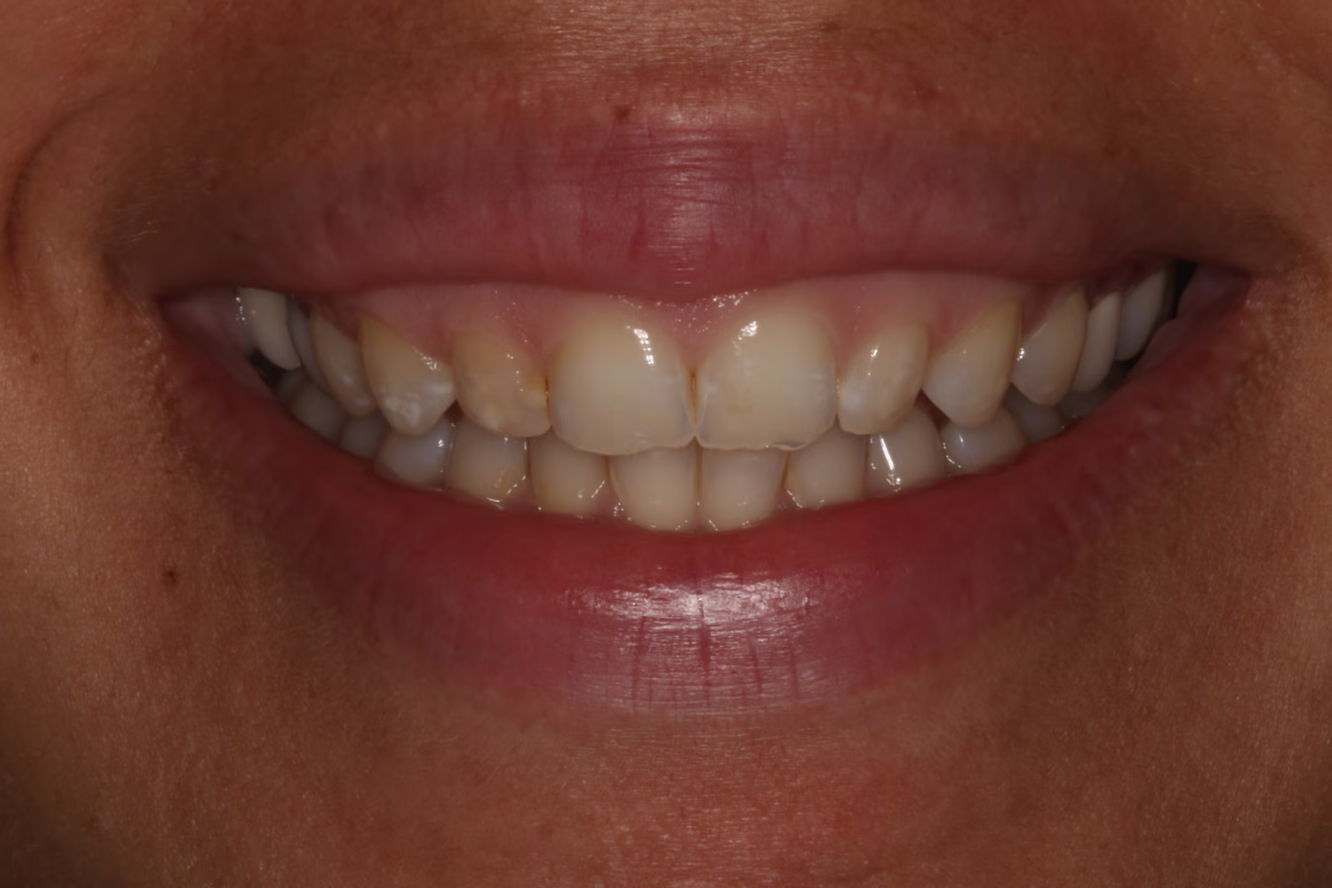 Georgetown Dentistry Smile Gallery Georgetown Dentistry Smile Gallery before gum recontouring migrated - Smile Gallery Georgetown Dentistry Smile Gallery Georgetown Dentistry Smile Gallery before gum recontouring migrated