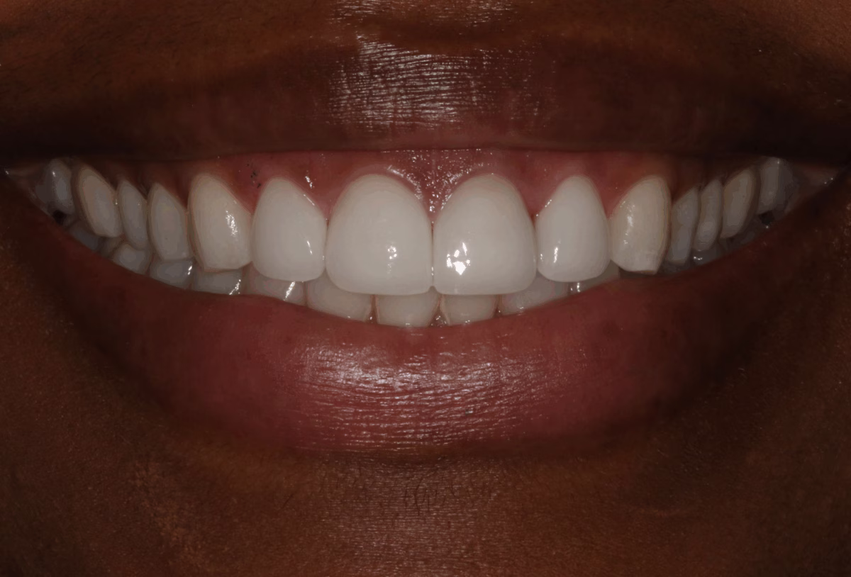 Georgetown Dentistry Smile Gallery Georgetown Dentistry Smile Gallery changing 4 old veneers after migrated - Smile Gallery Georgetown Dentistry Smile Gallery Georgetown Dentistry Smile Gallery changing 4 old veneers after migrated