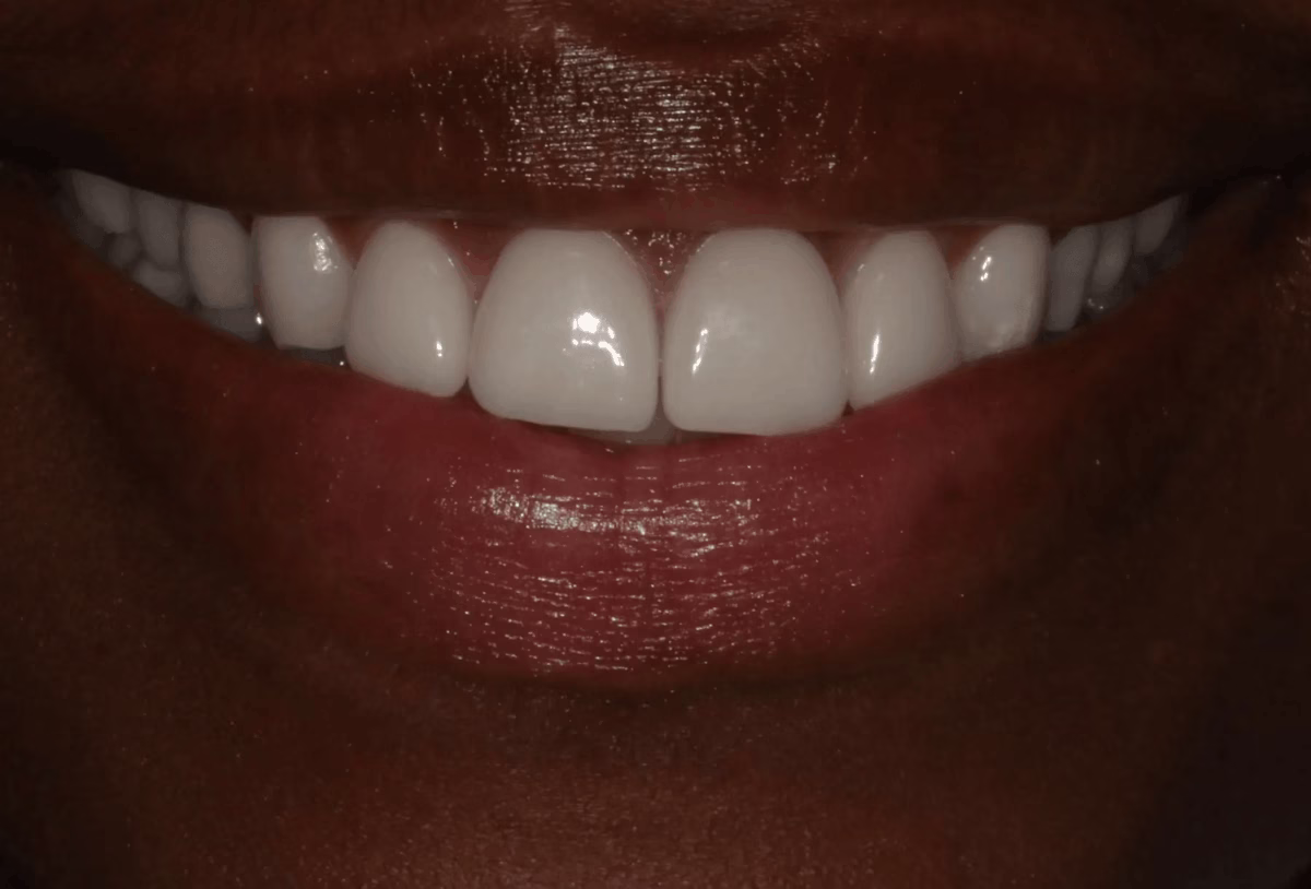 Georgetown Dentistry Smile Gallery Georgetown Dentistry Smile Gallery changing 4 old veneers before migrated - Smile Gallery Georgetown Dentistry Smile Gallery Georgetown Dentistry Smile Gallery changing 4 old veneers before migrated