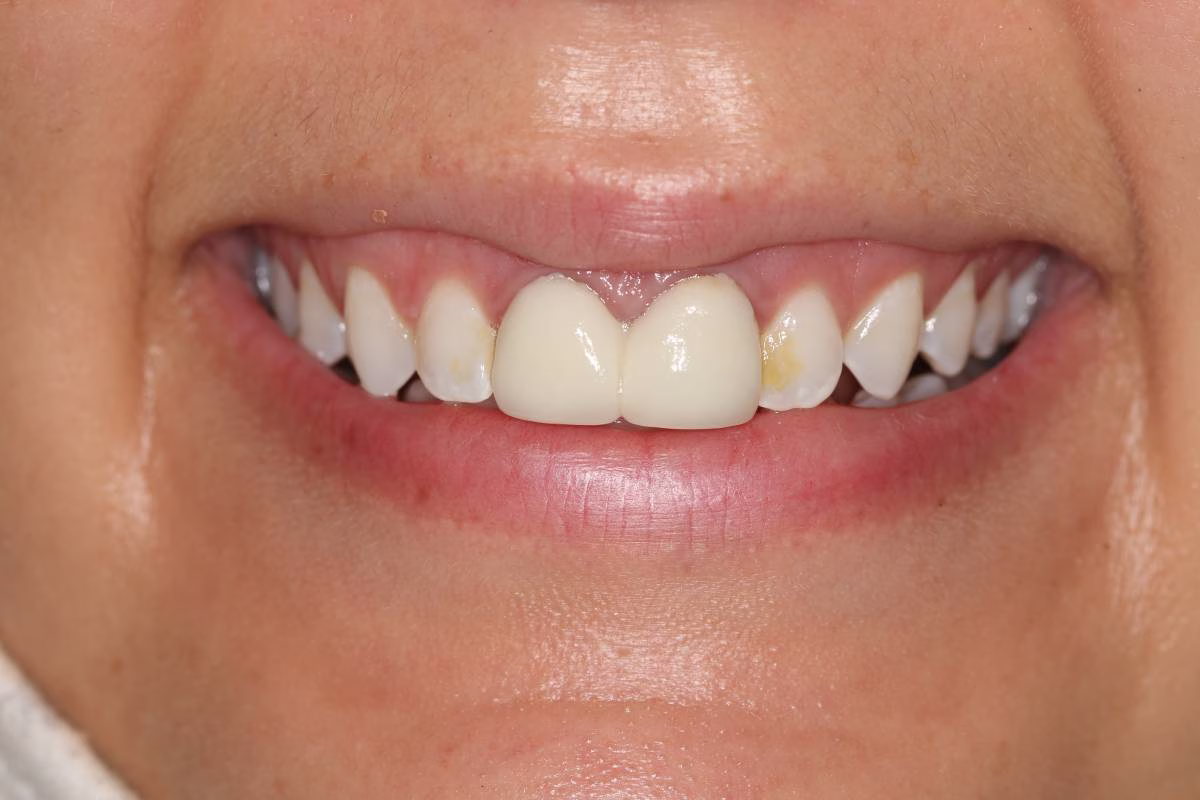 Georgetown Dentistry Smile Gallery img 0157 1 1 migrated - Smile Gallery Georgetown Dentistry Smile Gallery img 0157 1 1 migrated