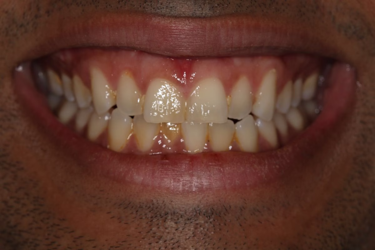 Georgetown Dentistry Smile Gallery img 0860 migrated - Smile Gallery Georgetown Dentistry Smile Gallery img 0860 migrated
