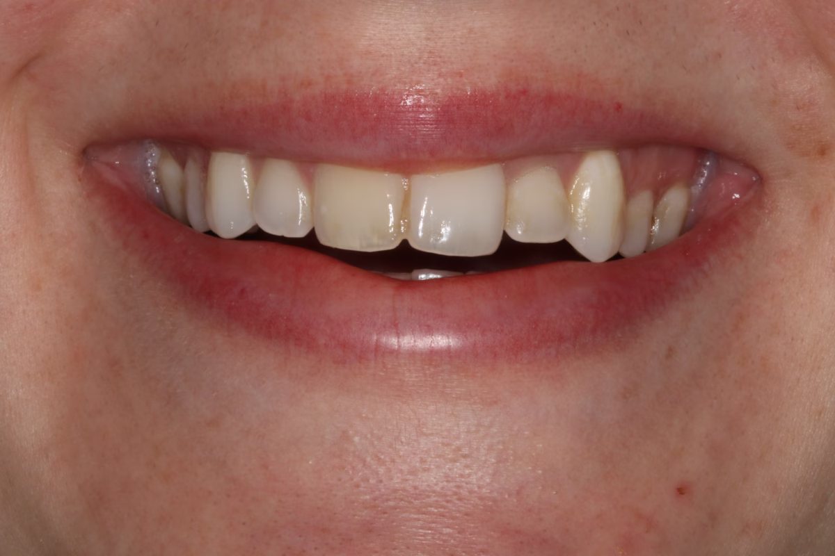 Georgetown Dentistry Smile Gallery img 9554 1 migrated - Smile Gallery Georgetown Dentistry Smile Gallery img 9554 1 migrated