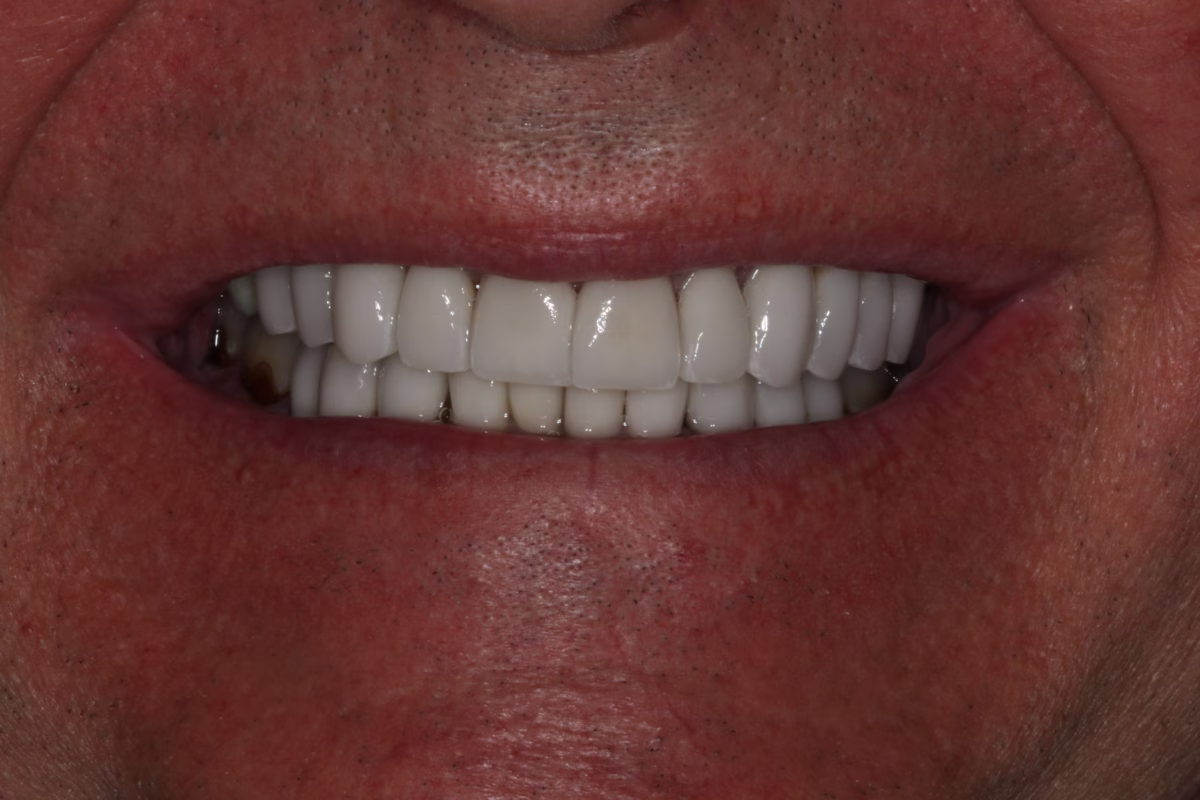 Georgetown Dentistry Smile Gallery img 9848 migrated - Smile Gallery Georgetown Dentistry Smile Gallery img 9848 migrated