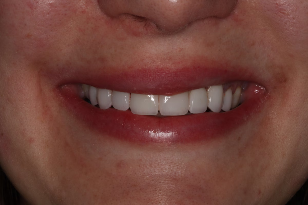 Georgetown Dentistry Smile Gallery img 9915 2 migrated - Smile Gallery Georgetown Dentistry Smile Gallery img 9915 2 migrated