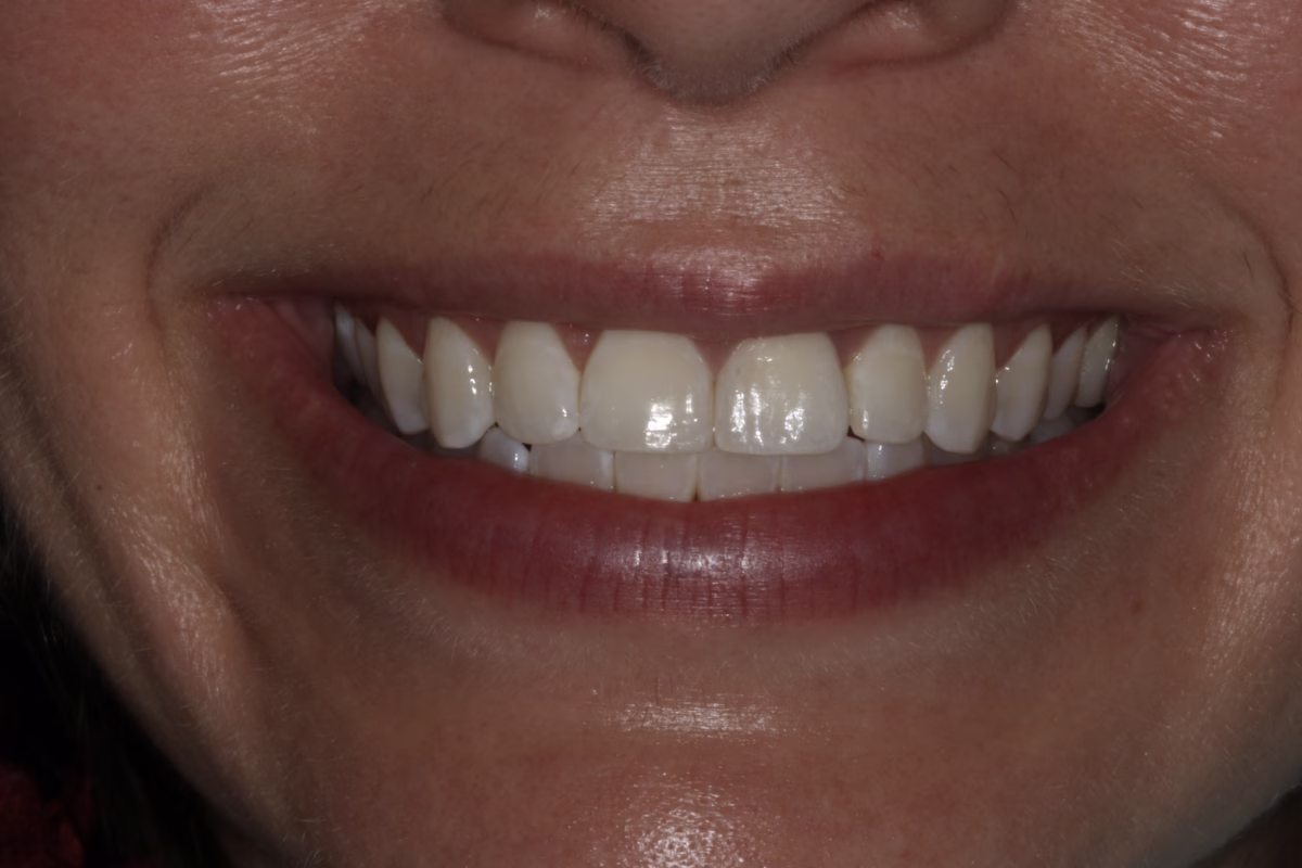 Georgetown Dentistry Smile Gallery img af migrated - Smile Gallery Georgetown Dentistry Smile Gallery img af migrated