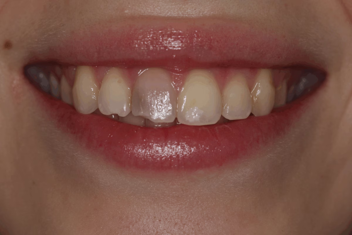 Georgetown Dentistry Smile Gallery internal whitening migrated - Smile Gallery Georgetown Dentistry Smile Gallery internal whitening migrated