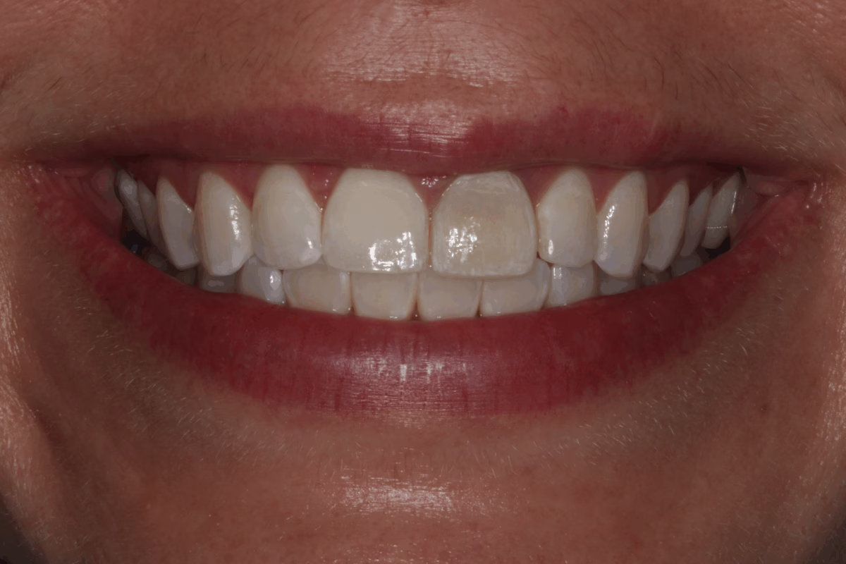 Georgetown Dentistry Smile Gallery single central before migrated - Smile Gallery Georgetown Dentistry Smile Gallery single central before migrated