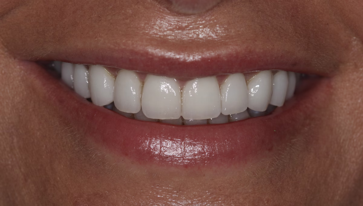 Georgetown Dentistry Smile Gallery veneer after migrated - Smile Gallery Georgetown Dentistry Smile Gallery veneer after migrated