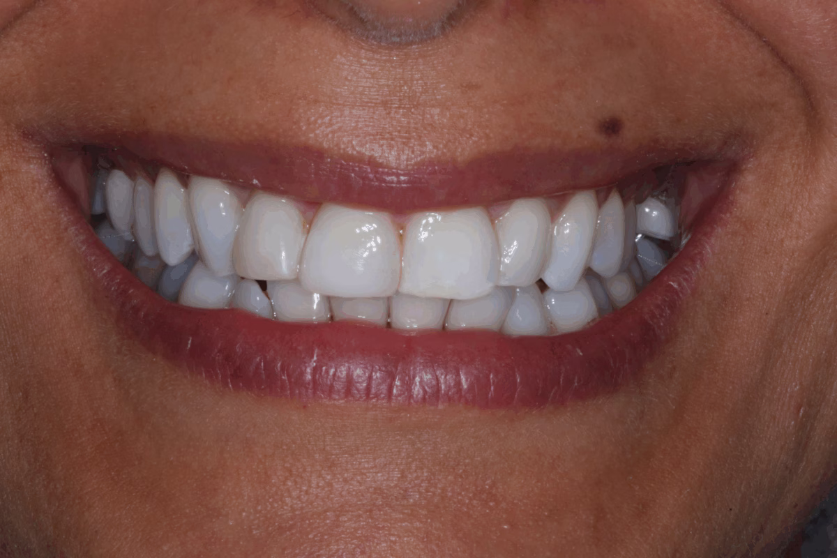 Georgetown Dentistry Smile Gallery whitening after migrated - Smile Gallery Georgetown Dentistry Smile Gallery whitening after migrated
