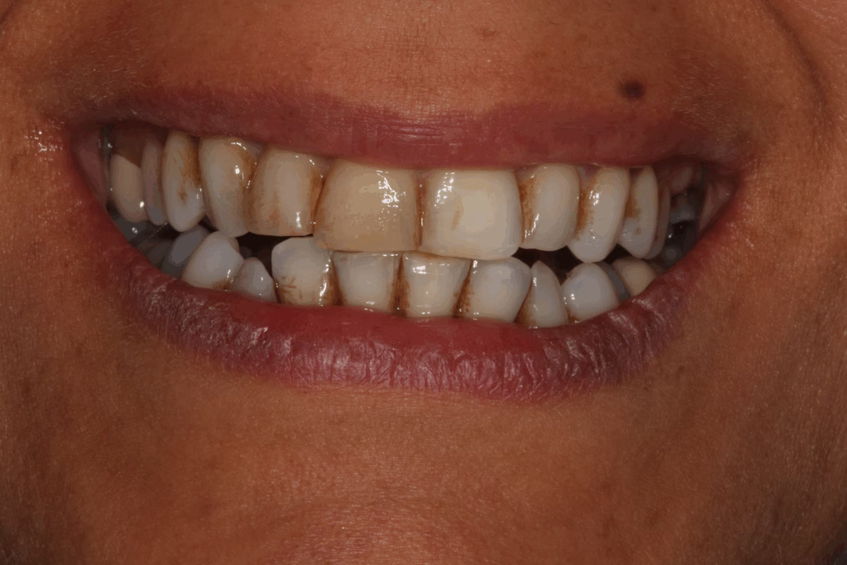 Georgetown Dentistry Smile Gallery whitening before migrated - Smile Gallery Georgetown Dentistry Smile Gallery whitening before migrated