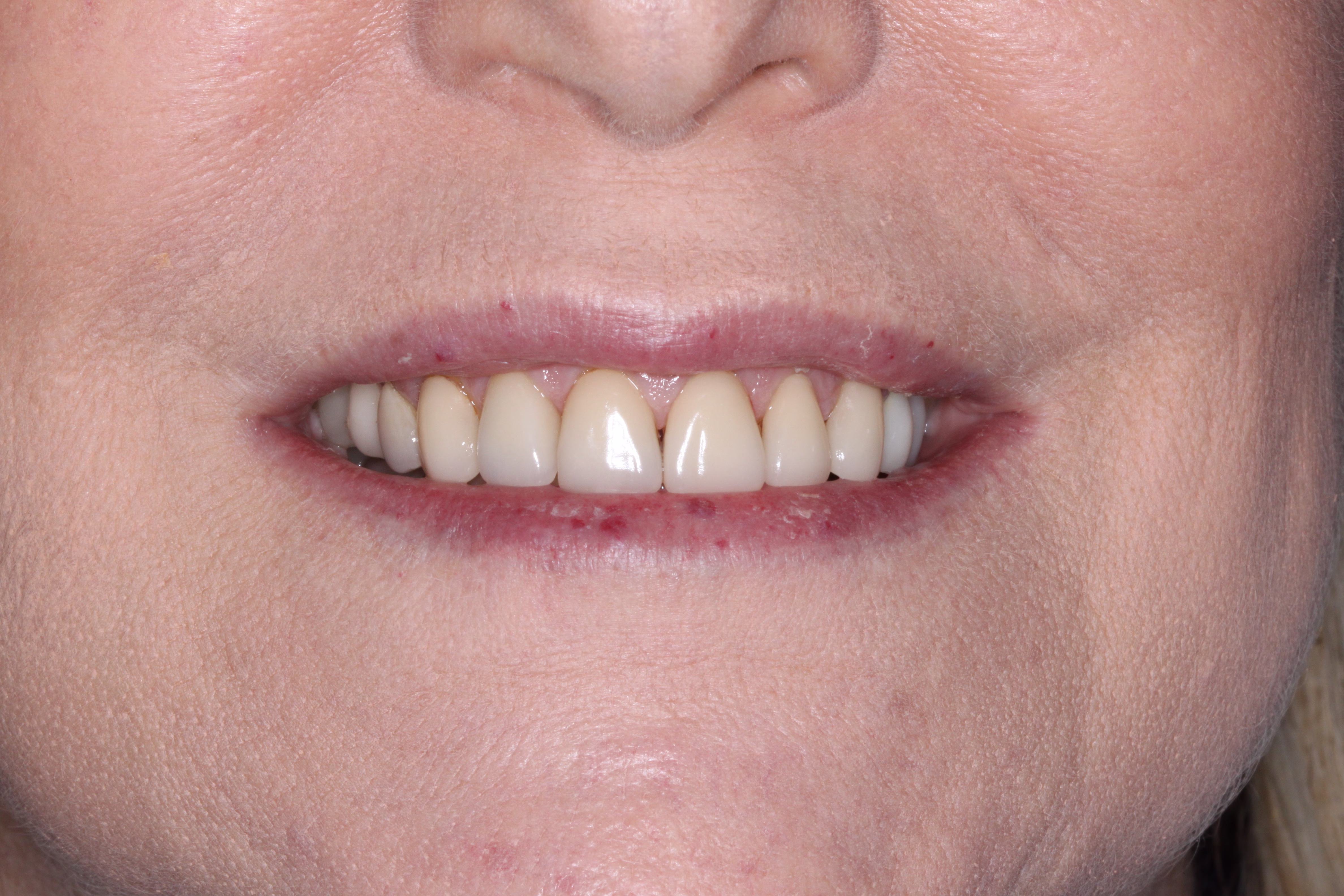 Georgetown Smile Makeover and veneers patient before