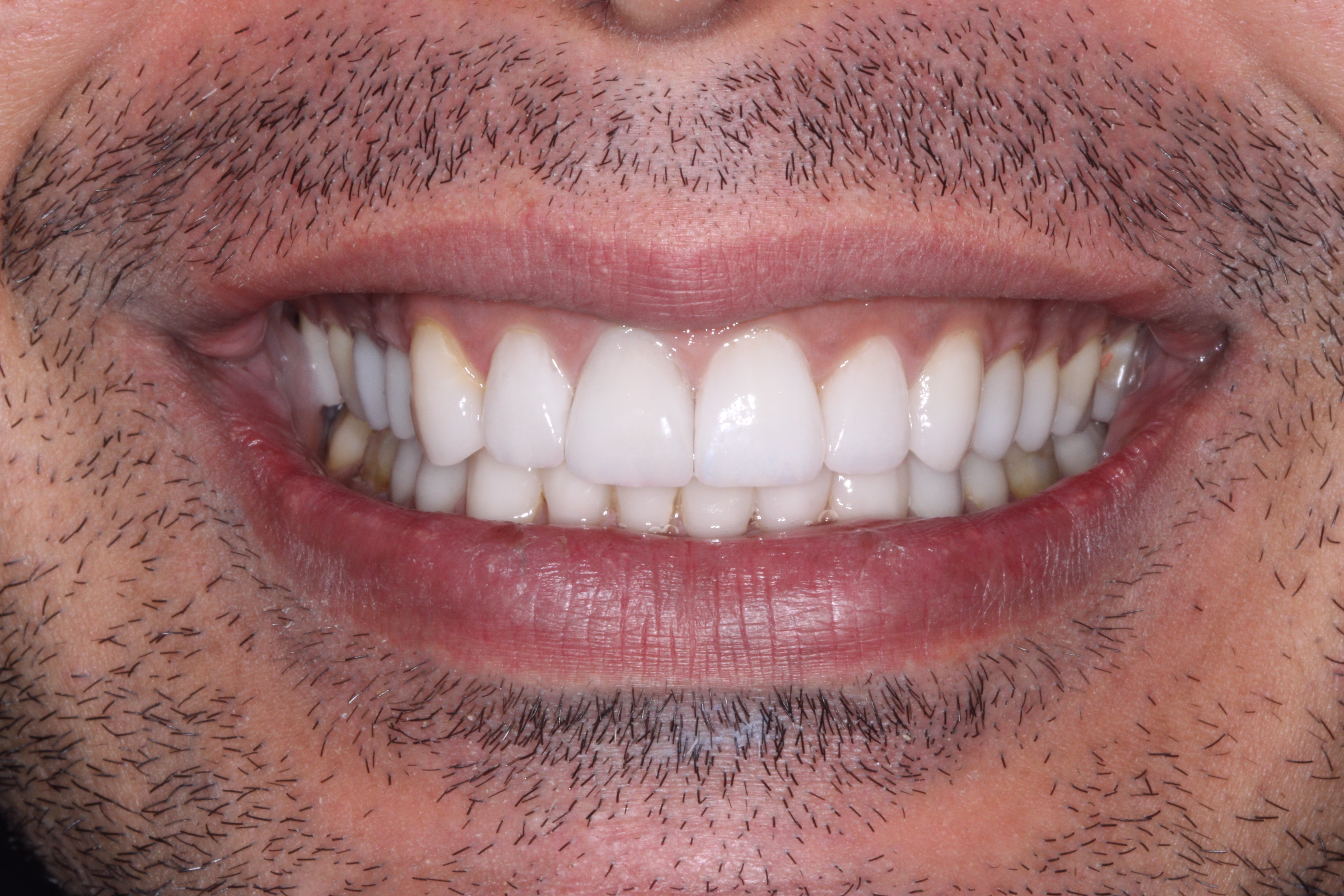 Georgetown cosmetic dentsitry patient with veneers crowns and full reconstruction after
