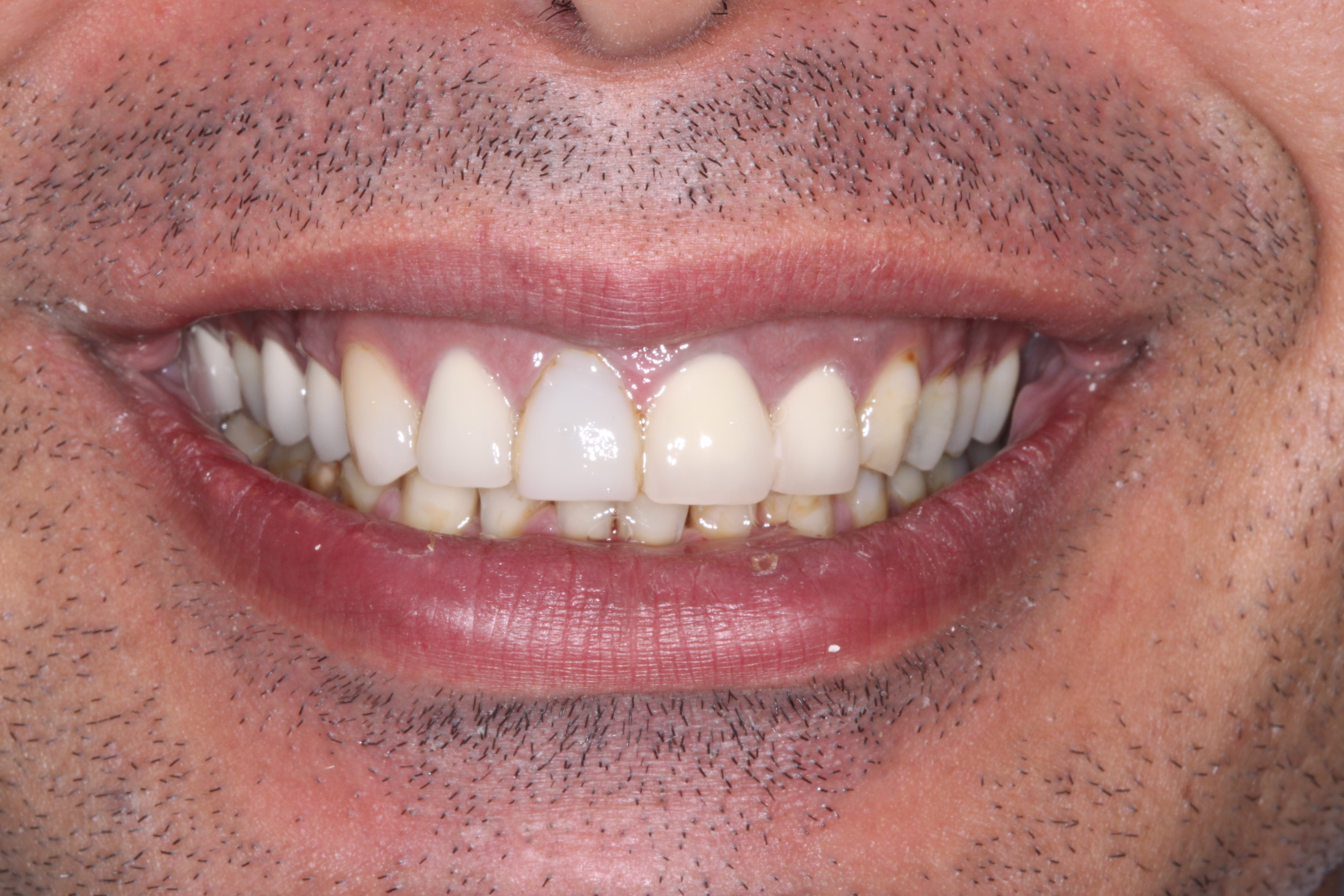 Georgetown cosmetic dentsitry patient with veneers crowns and full reconstruction before