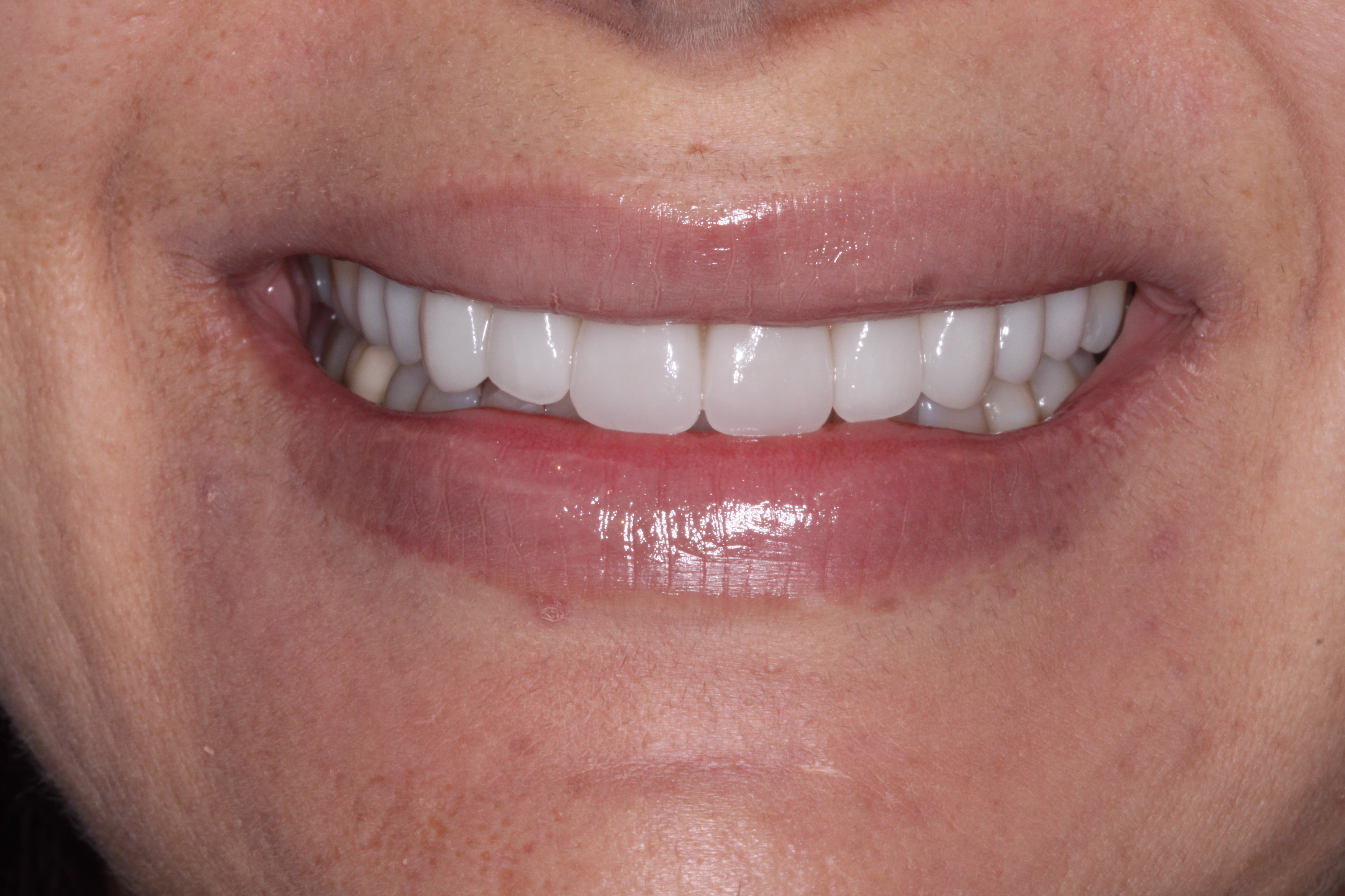 Porcelain Veneers Georgetown Cosmetic Dentistry Washington DC after - Mojgan's Smile Story Porcelain Veneers Georgetown Cosmetic Dentistry Washington DC after