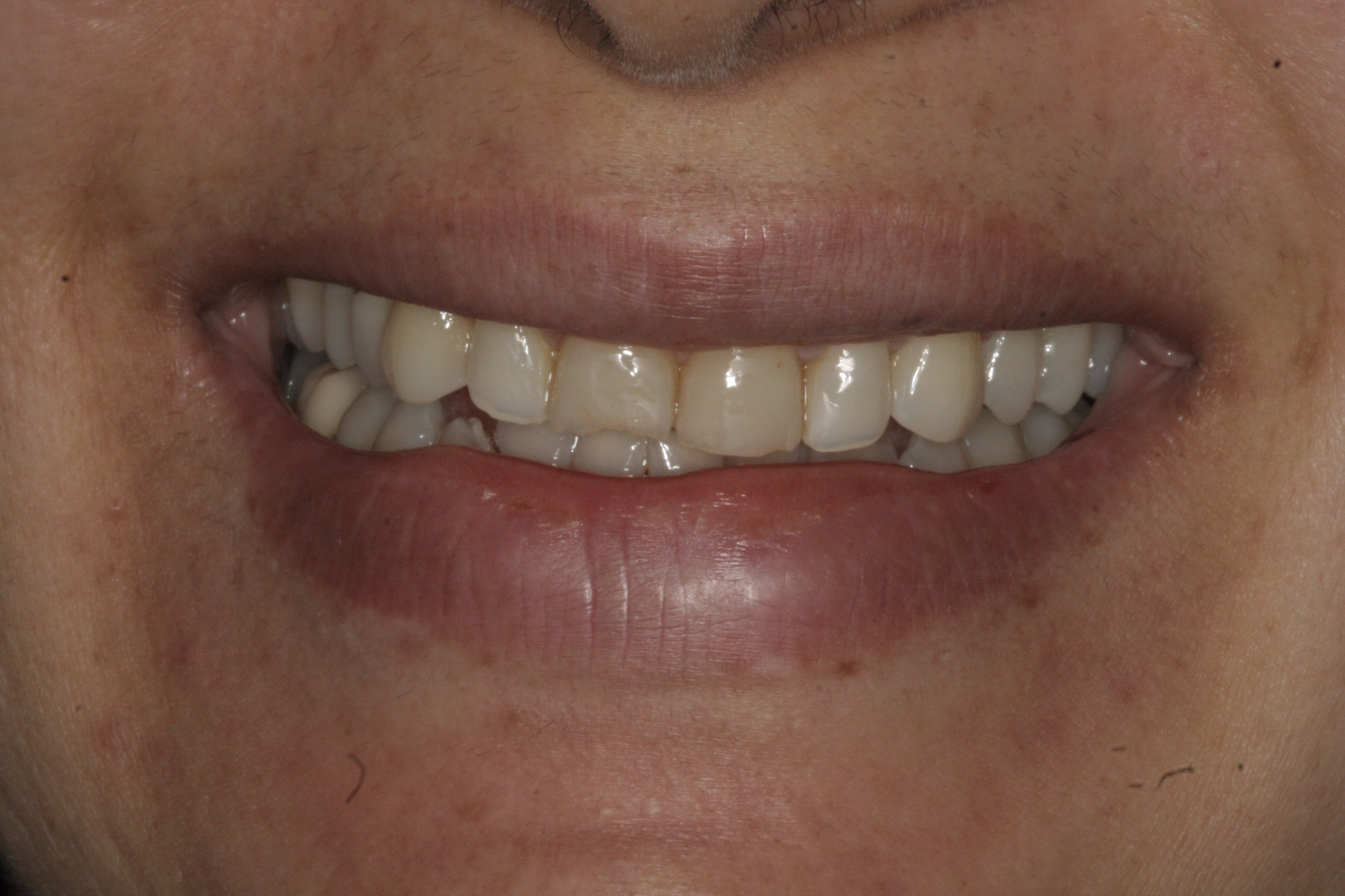 Porcelain Veneers Georgetown Cosmetic Dentistry Washington DC before - Mojgan's Smile Story Porcelain Veneers Georgetown Cosmetic Dentistry Washington DC before