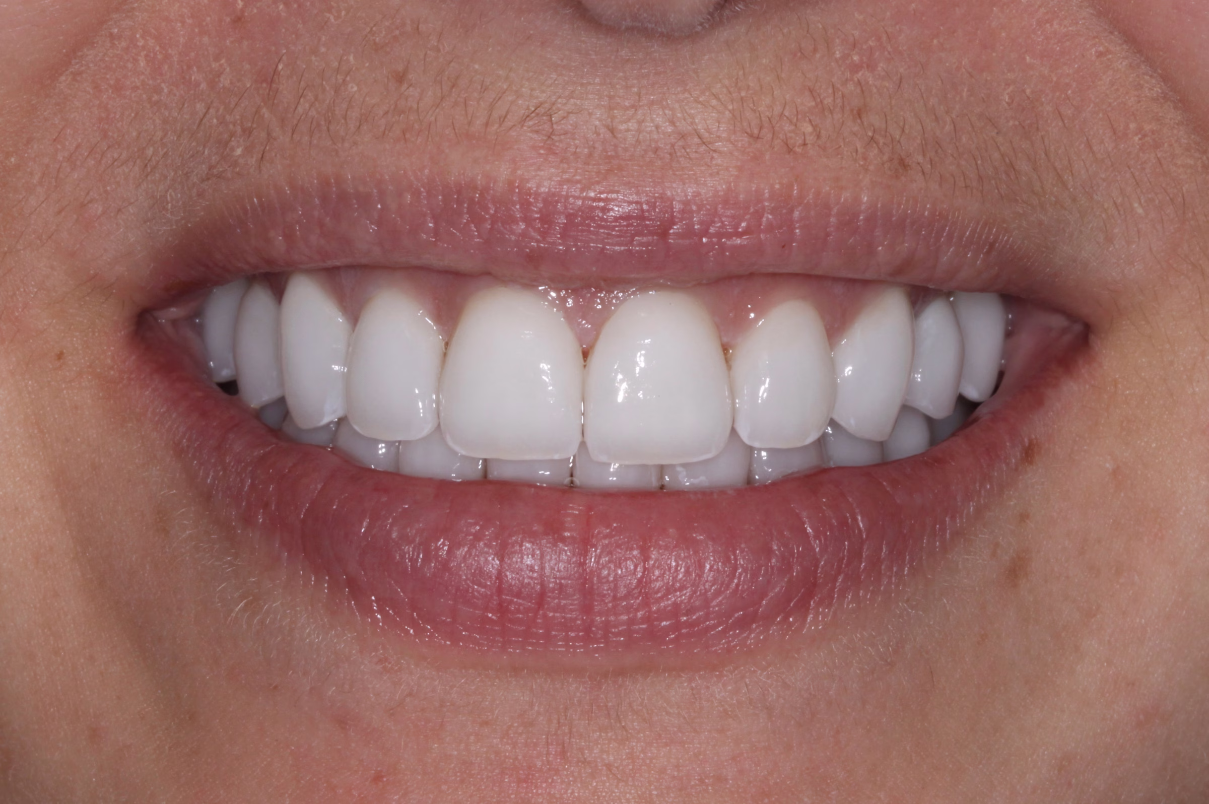Washington DC cosmetic dentistry patient veneers and full mouth reconstruction Erin after - Porcelain Veneers Washington DC cosmetic dentistry patient veneers and full mouth reconstruction Erin after