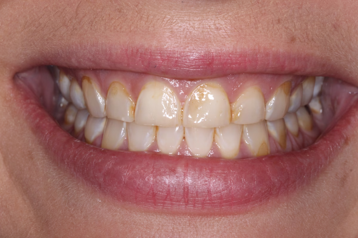 Washington DC cosmetic dentistry patient veneers and full mouth reconstruction Erin before