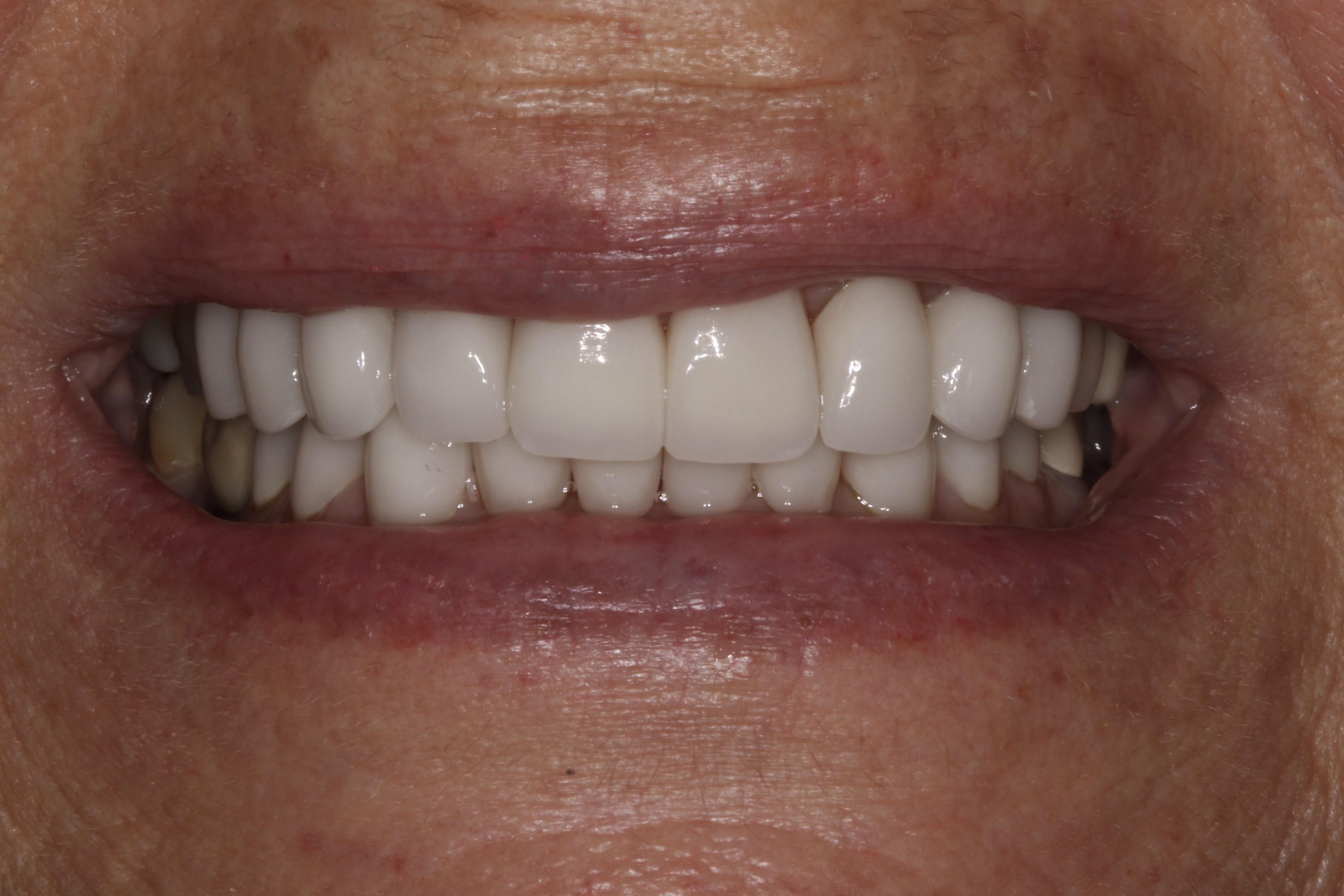 Washington DC cosmetic dentistry patient veneers and full mouth reconstruction after