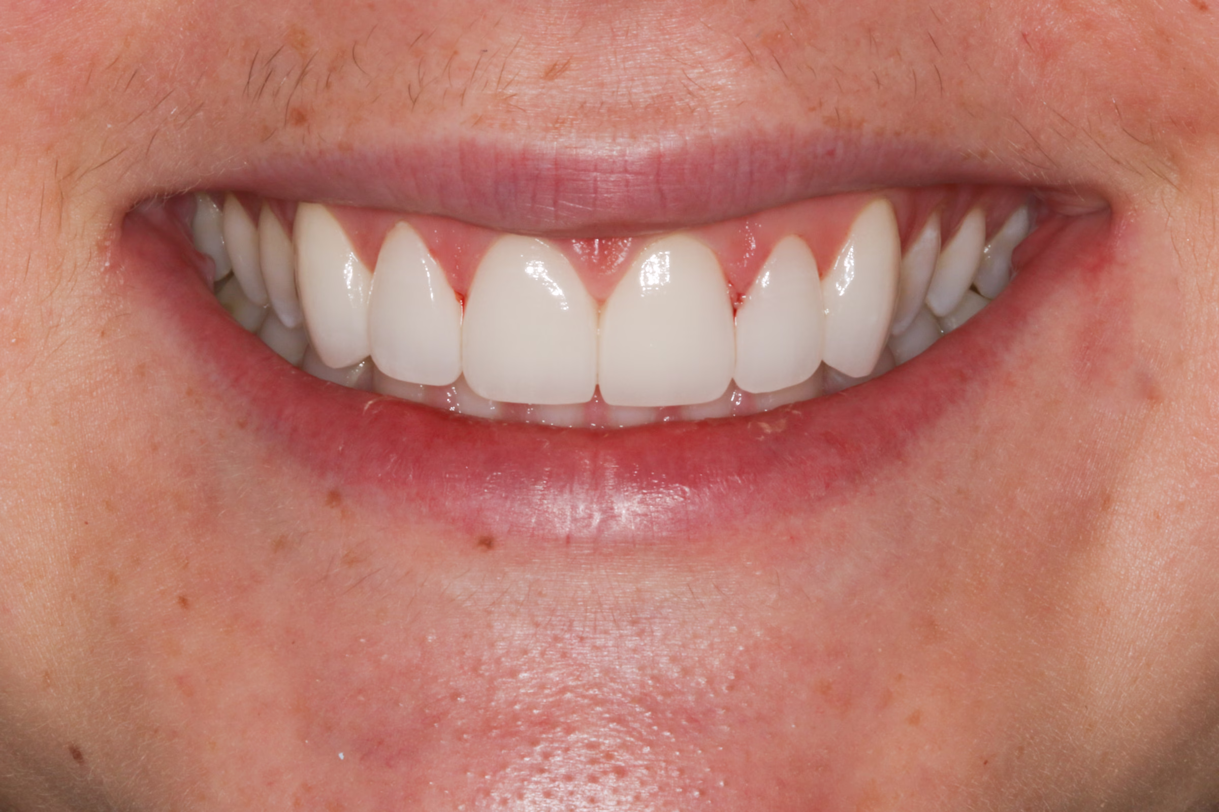 Georgetown Cosmetic Dentistry Before and After 1